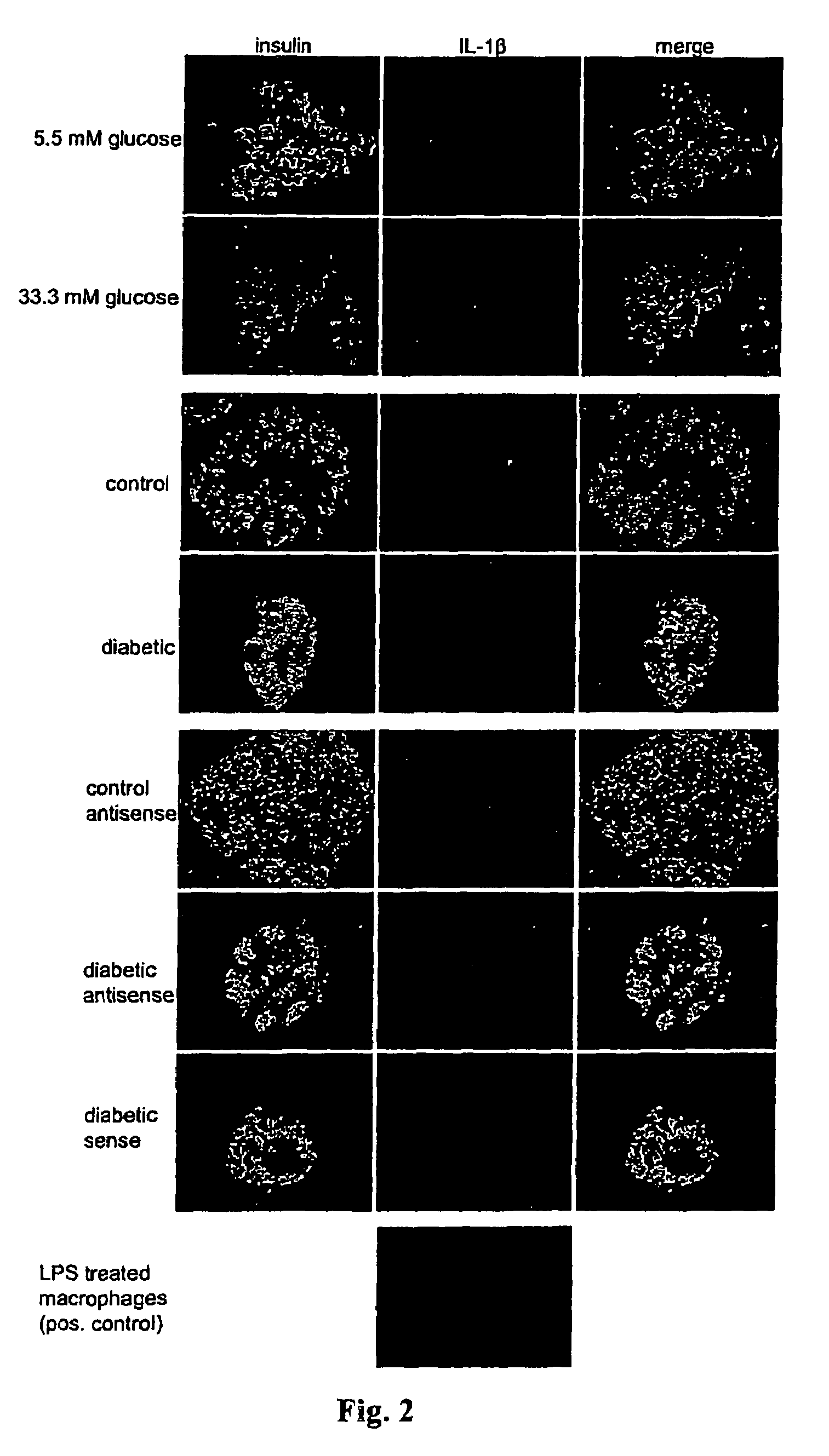 Use of an interleukin 1 receptor antagonist and/or pyrrolidinedithiocarbamate for the treatment or prophylaxis of type 2 diabetes