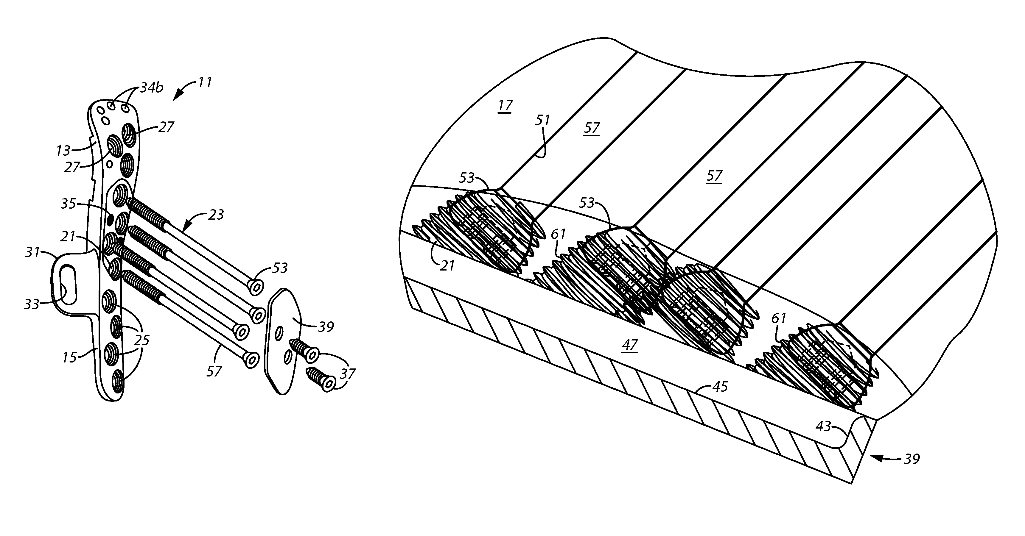 Bone plate system for repair of proximal humeral fracture