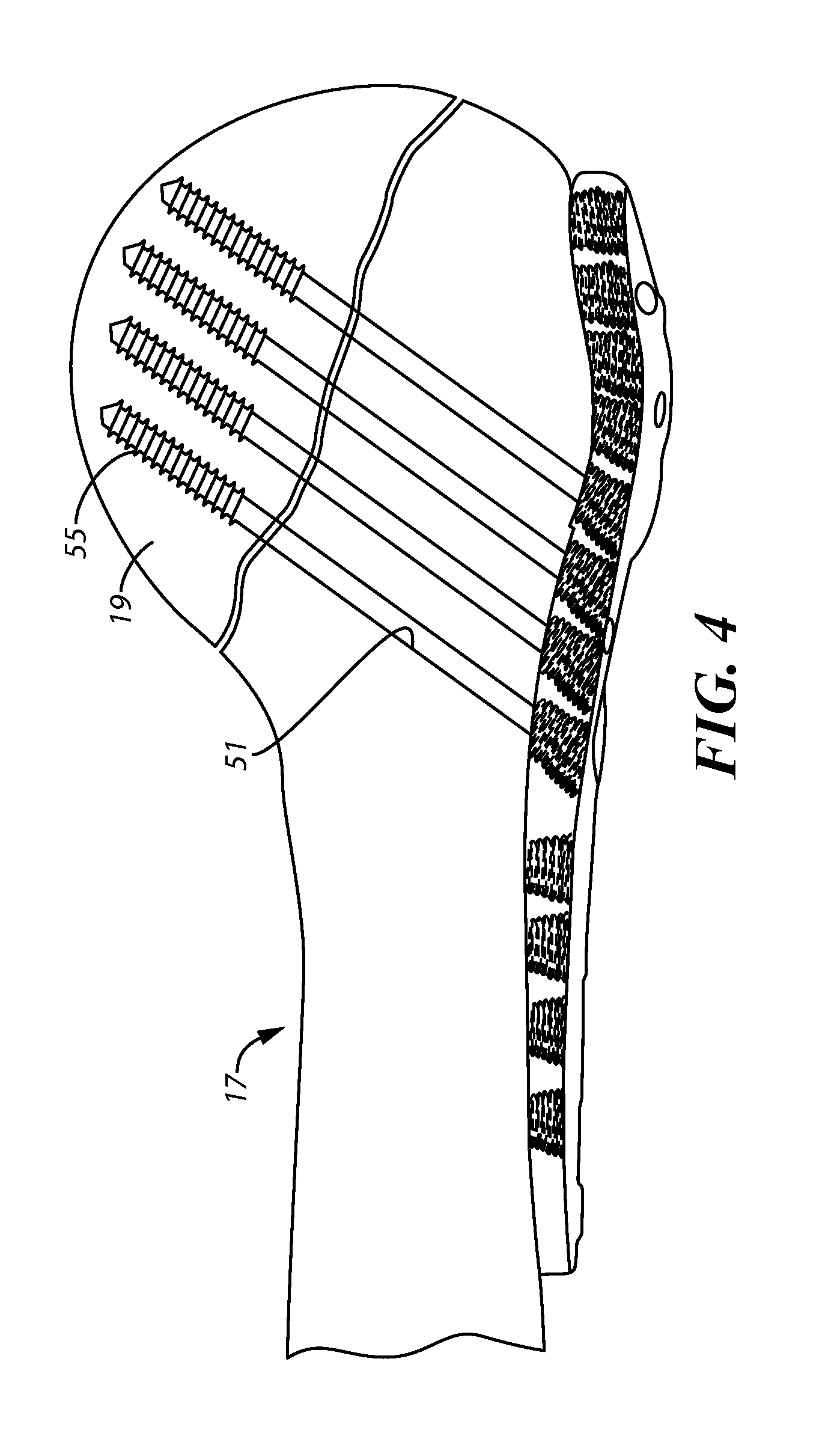 Bone plate system for repair of proximal humeral fracture