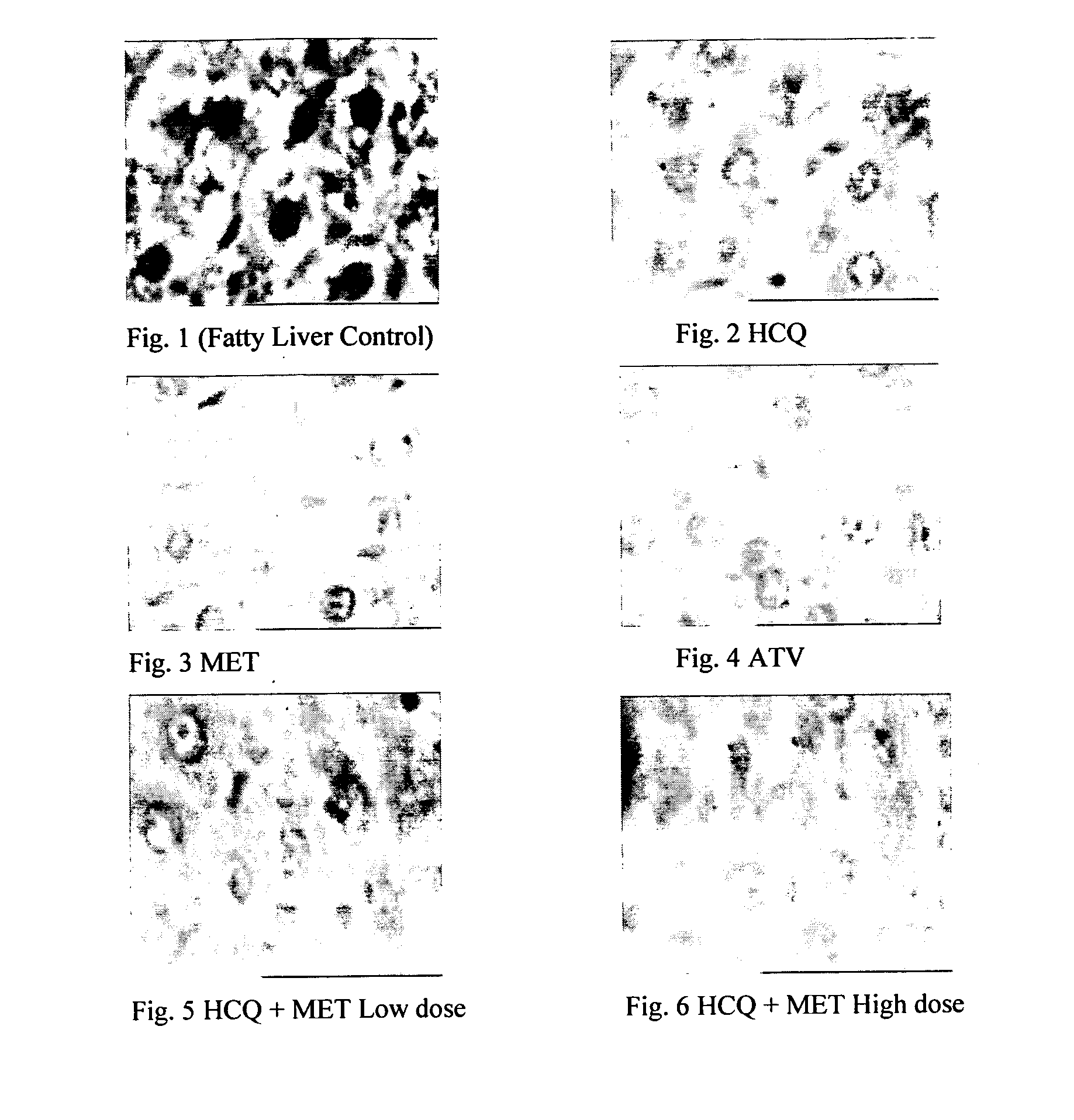 Pharmaceutical compositions for the treatment/prophylaxis of non-alcoholic fatty liver disease