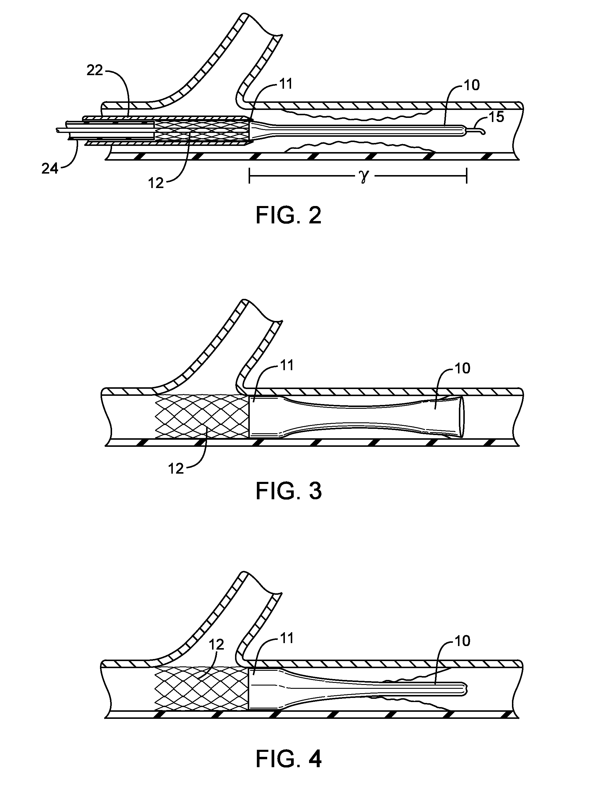 Methods and devices for protecting a passageway in a body when advancing devices through the passageway