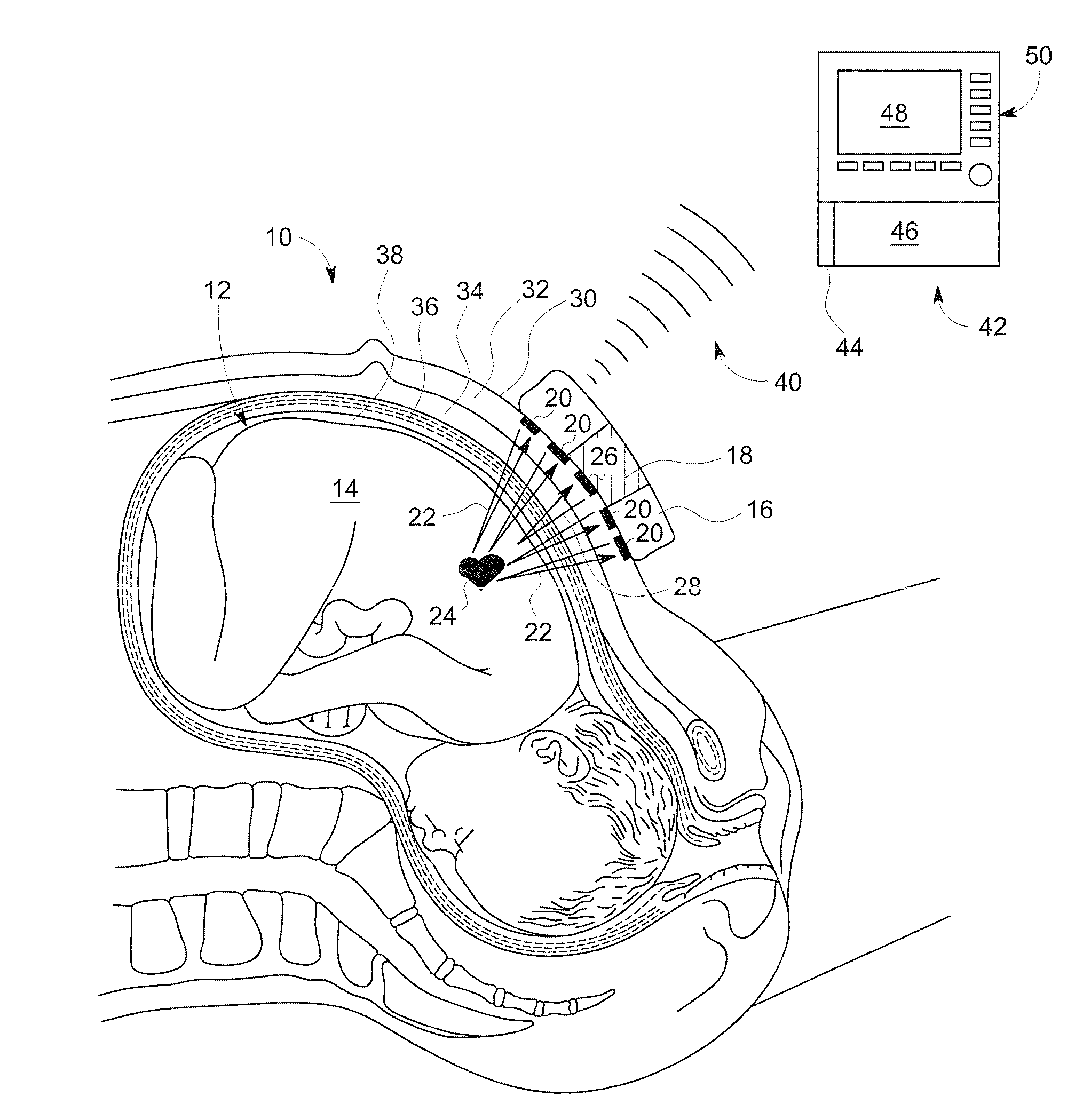 Abdominal Sonar System and Apparatus