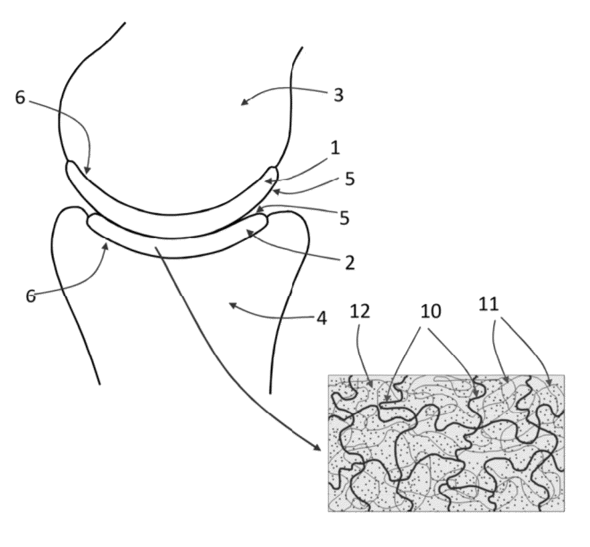 Hydrogel Arthroplasty Device