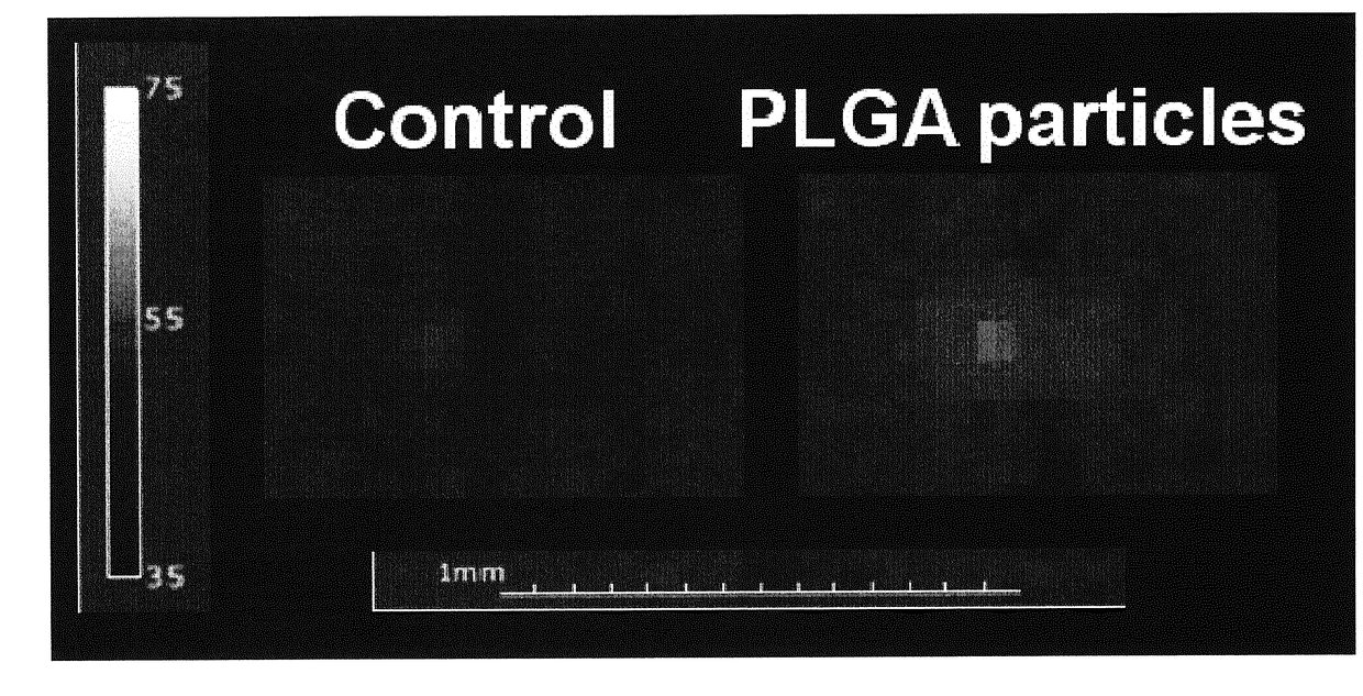 Polymeric Nanoparticles for Enhancing HIFU-Induced Ablation