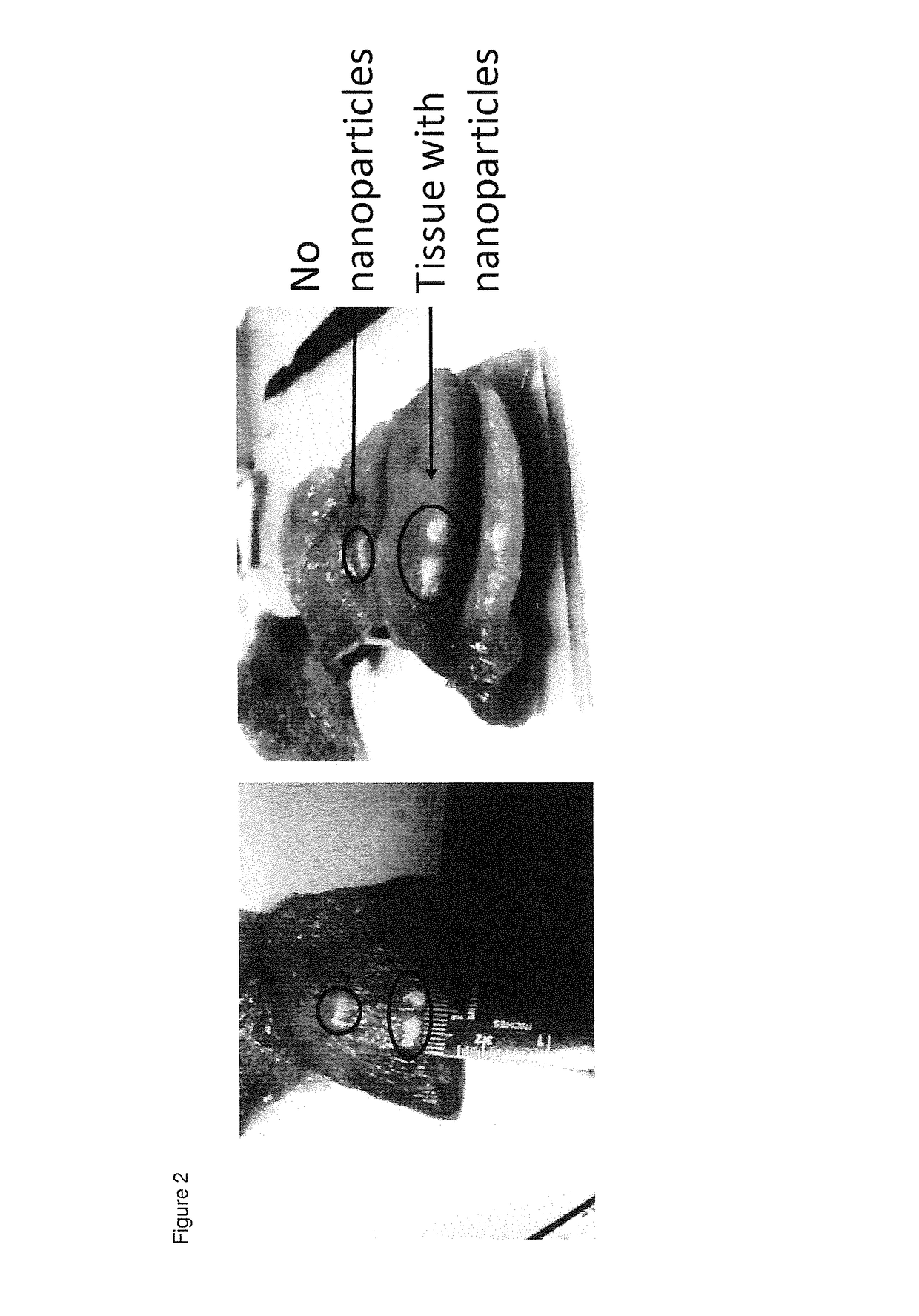 Polymeric Nanoparticles for Enhancing HIFU-Induced Ablation