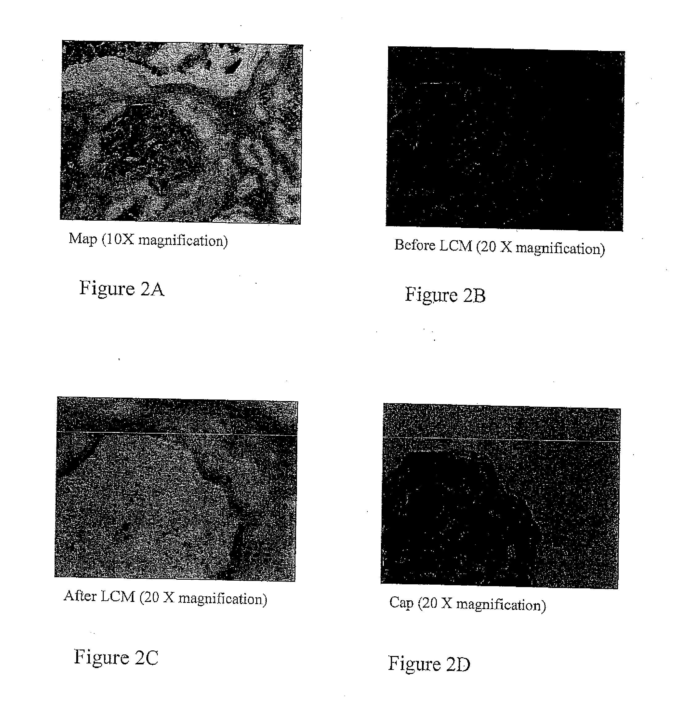 Methods for identifying an increased likelihood of recurrence of breast cancer