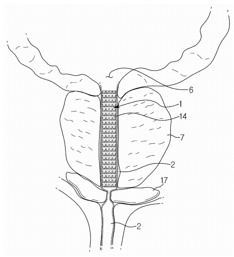 Urethral stent for the prostate