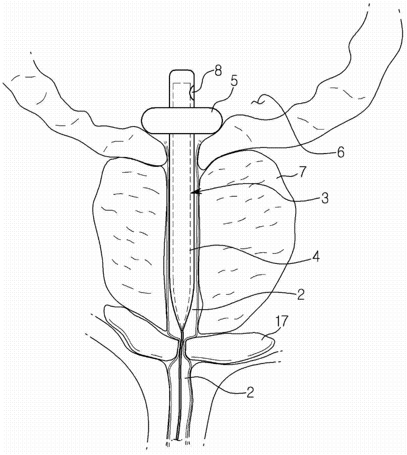 Urethral stent for the prostate