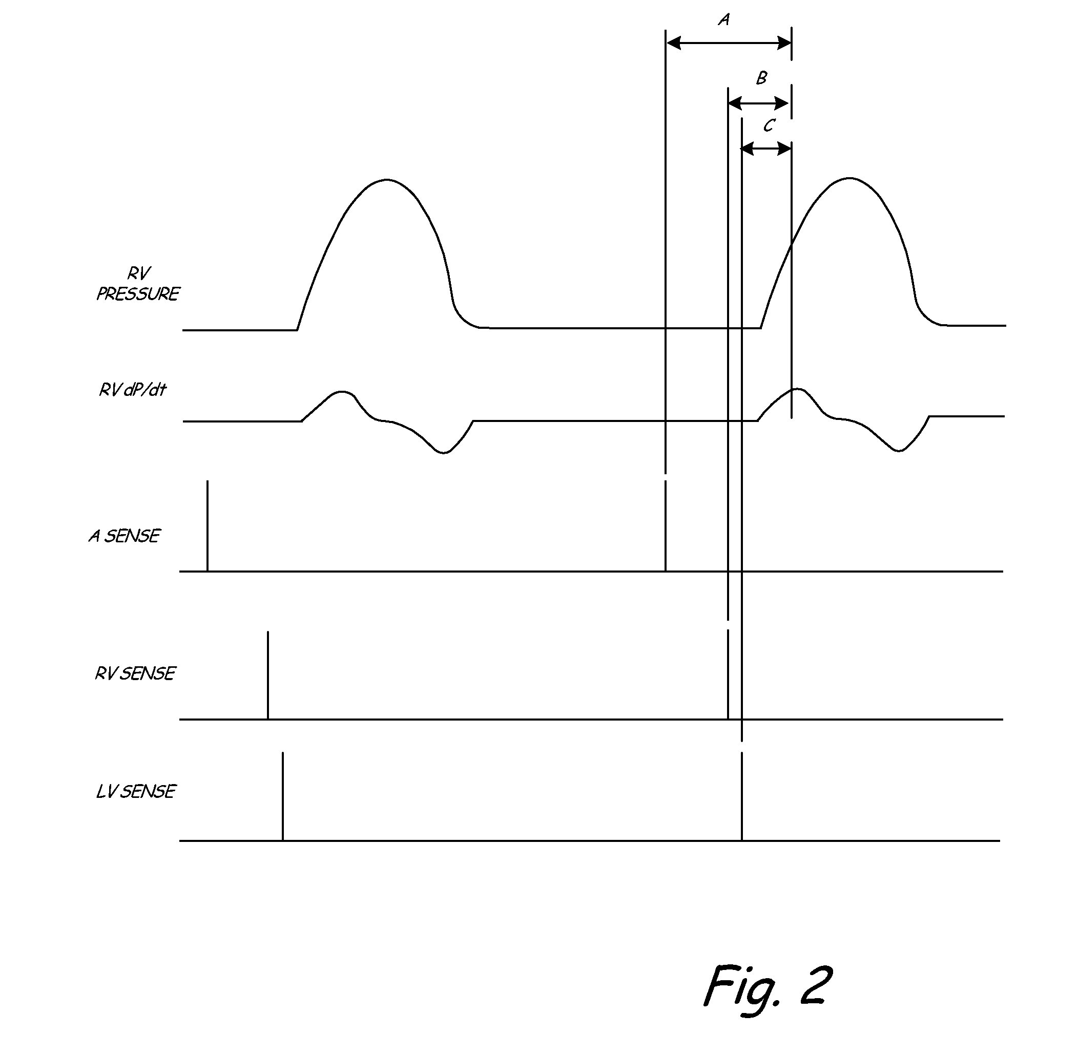 Implantable medical device with electromechanical delay measurement for lead position and ventricular