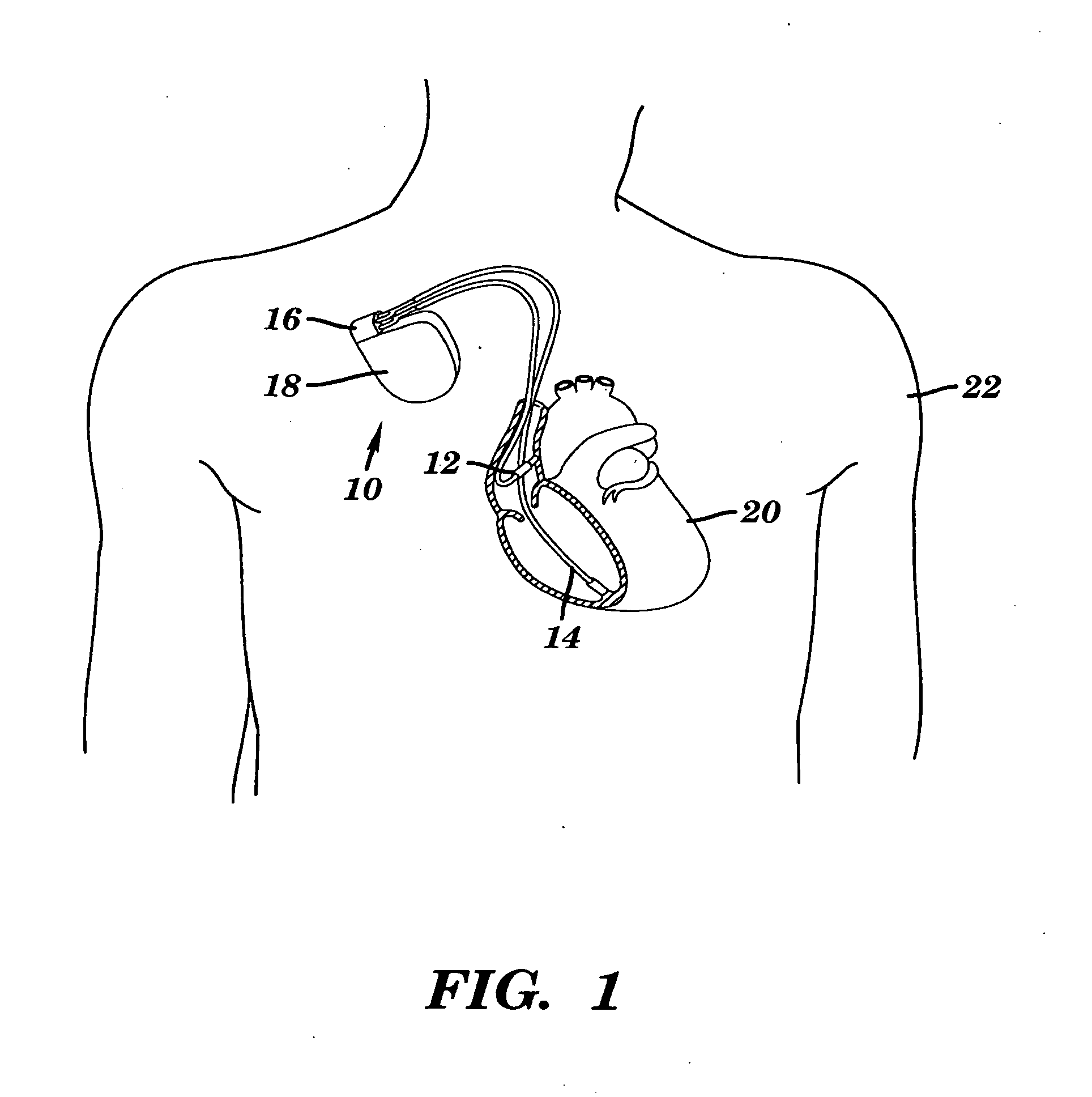 Pacemaker with neurocardiogenic syncope detection and therapy utilizing minute ventilation input