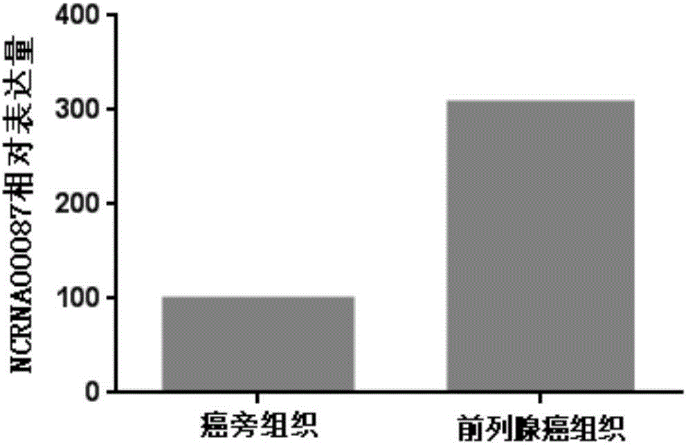 Diagnosis and treatment marker of prostate cancer