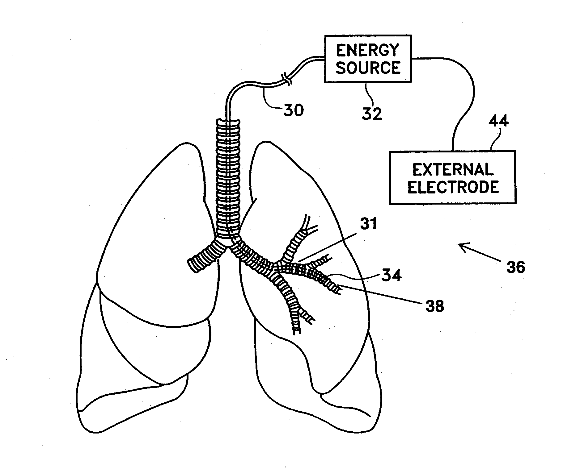 Method for treating an asthma attack