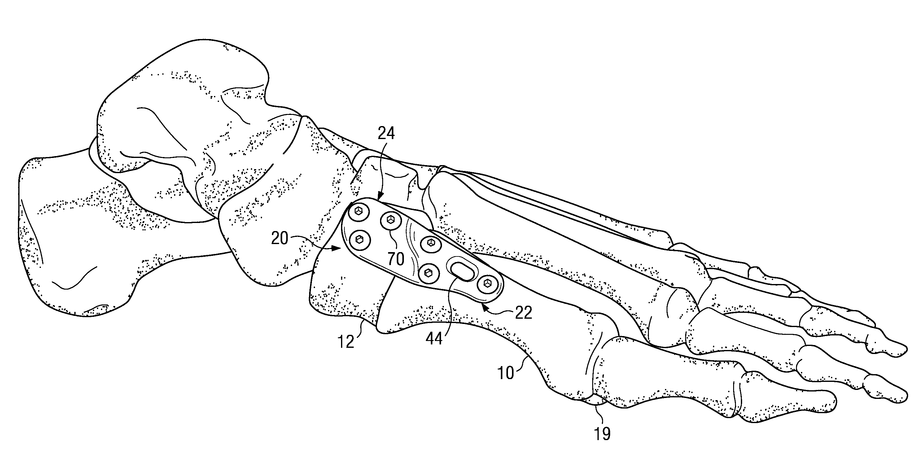 Fixation plate for use in the Lapidus approach