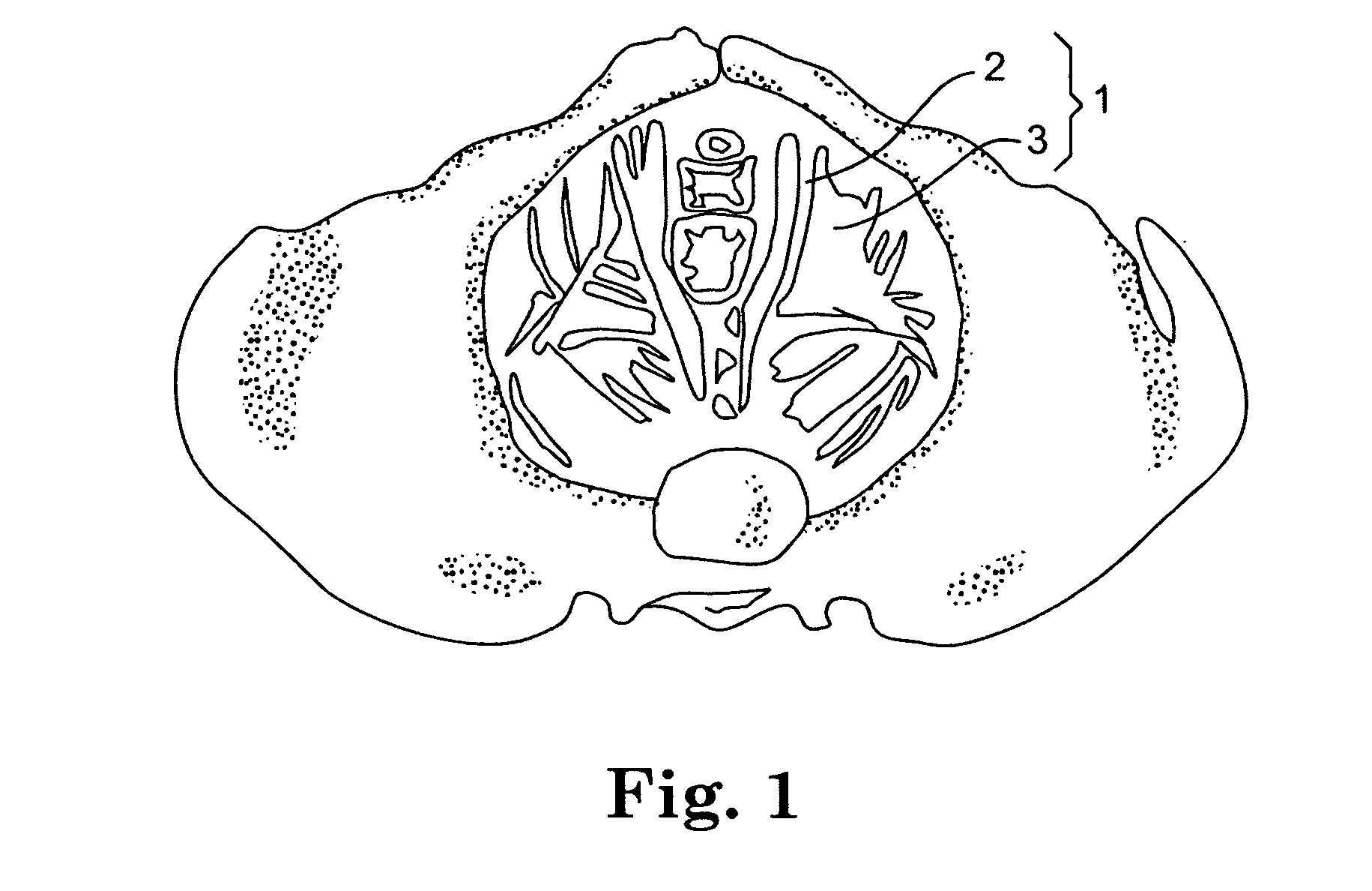 Method and apparatus for levator distension repair