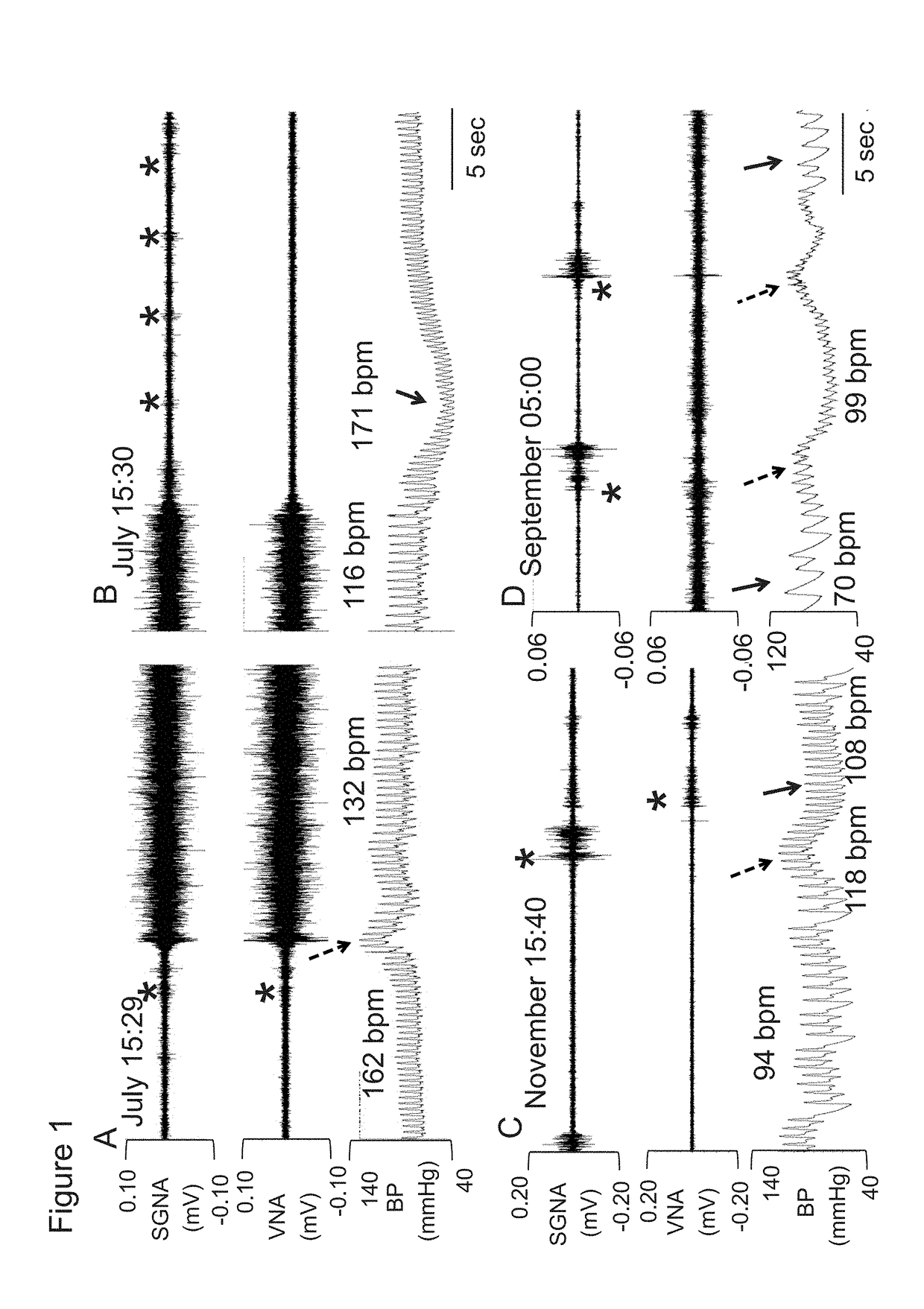 Beta 2 adrenoceptor antagonists for treating orthostatic hypotension