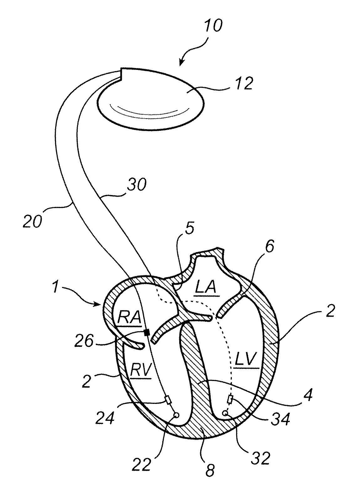 Implantable medical device and method for classifying arrhythmia events