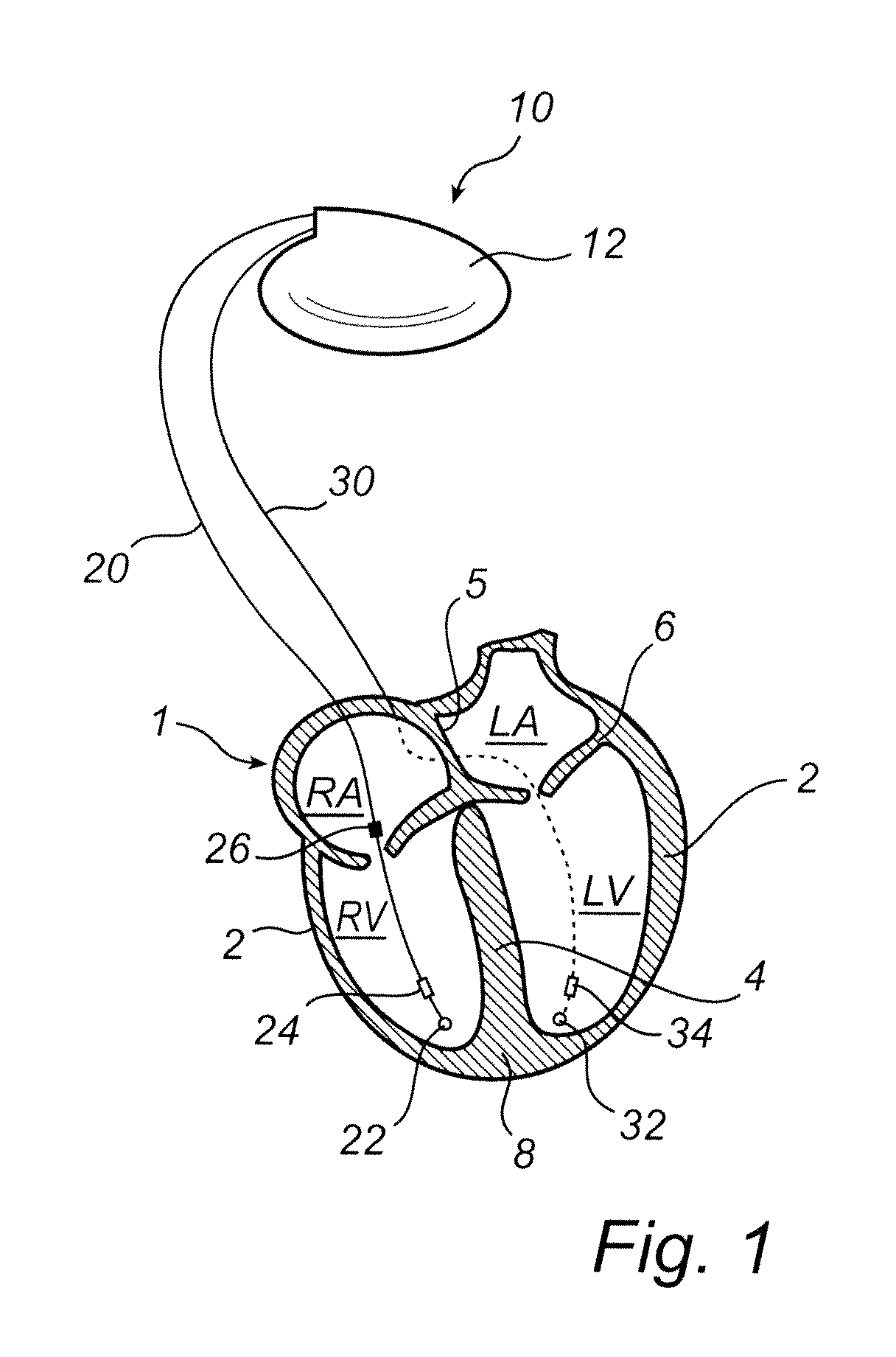 Implantable medical device and method for classifying arrhythmia events