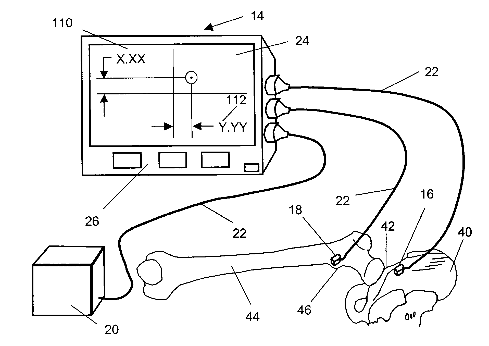 Apparatus and methods for making intraoperative orthopedic measurements