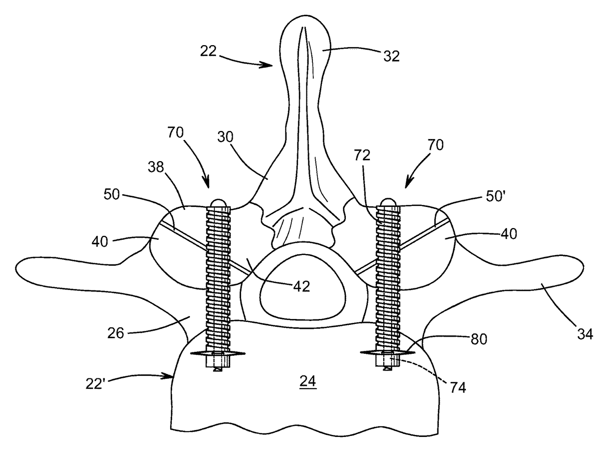 Bioactive fusion device