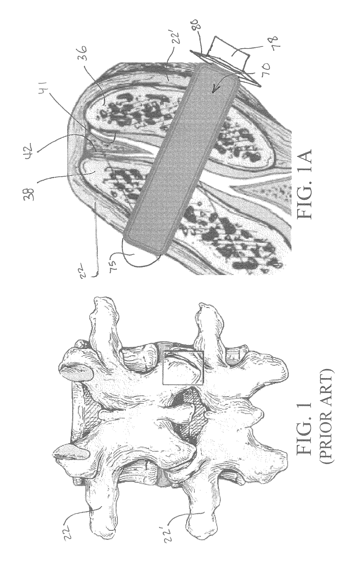 Bioactive fusion device