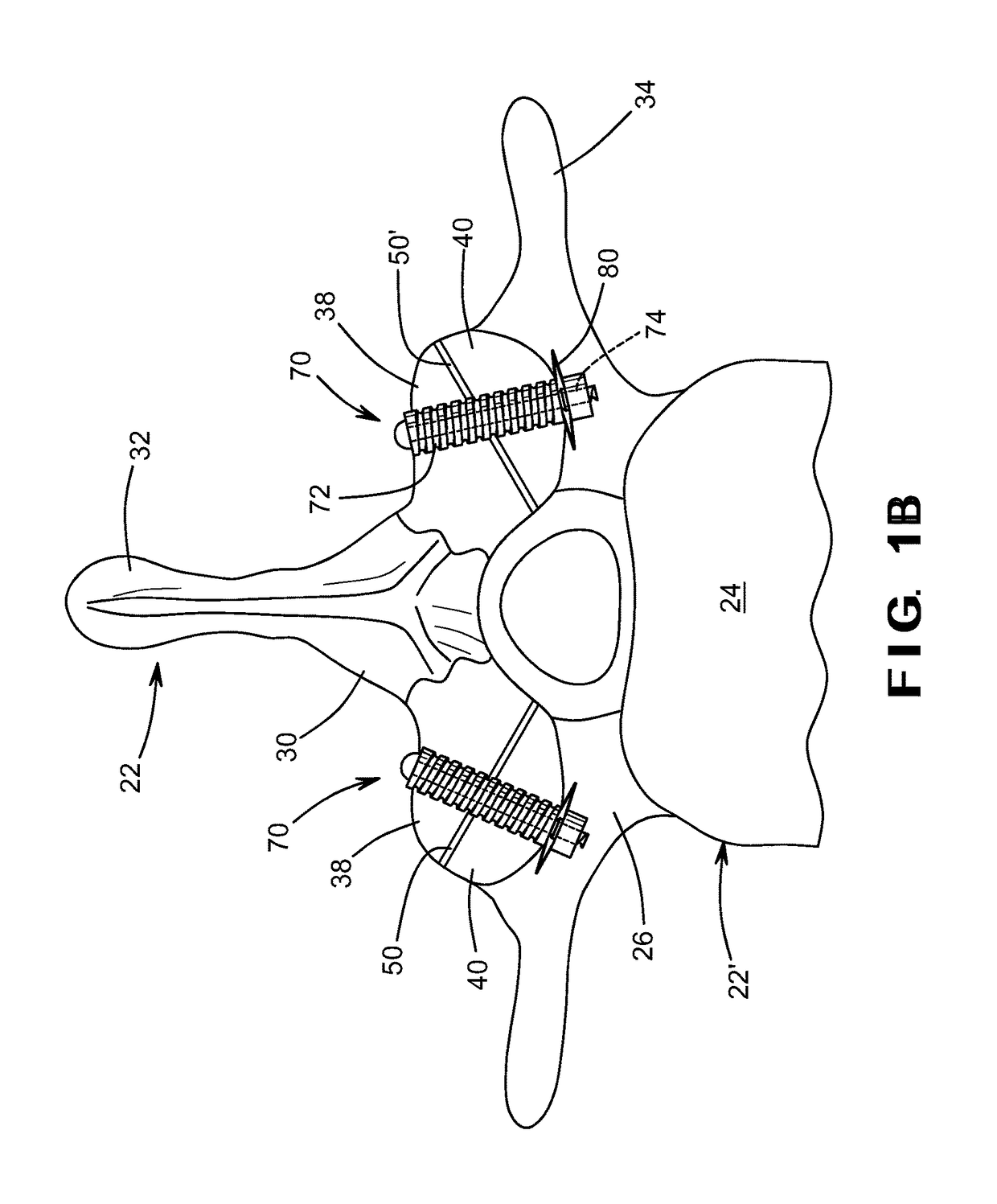 Bioactive fusion device