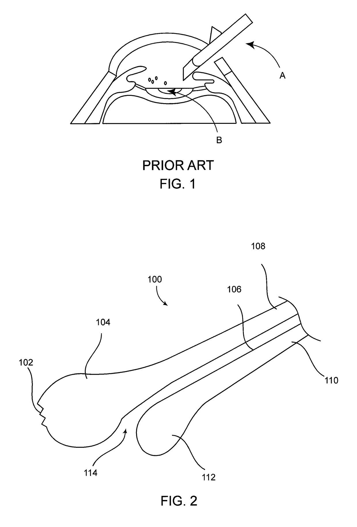 Cataract removal device and integrated tip