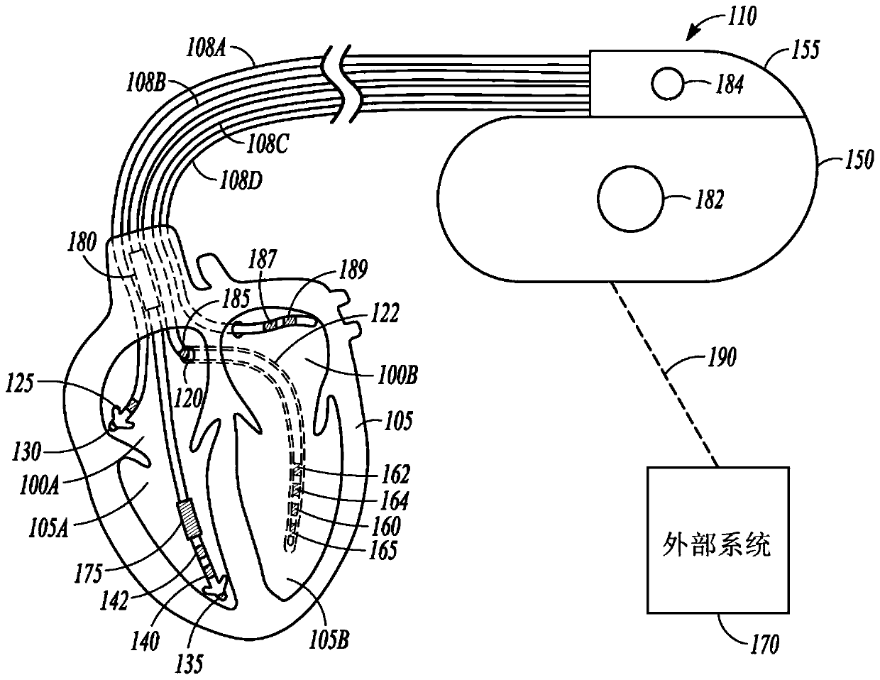 Conduction pathway driven multi-site pacing apparatus