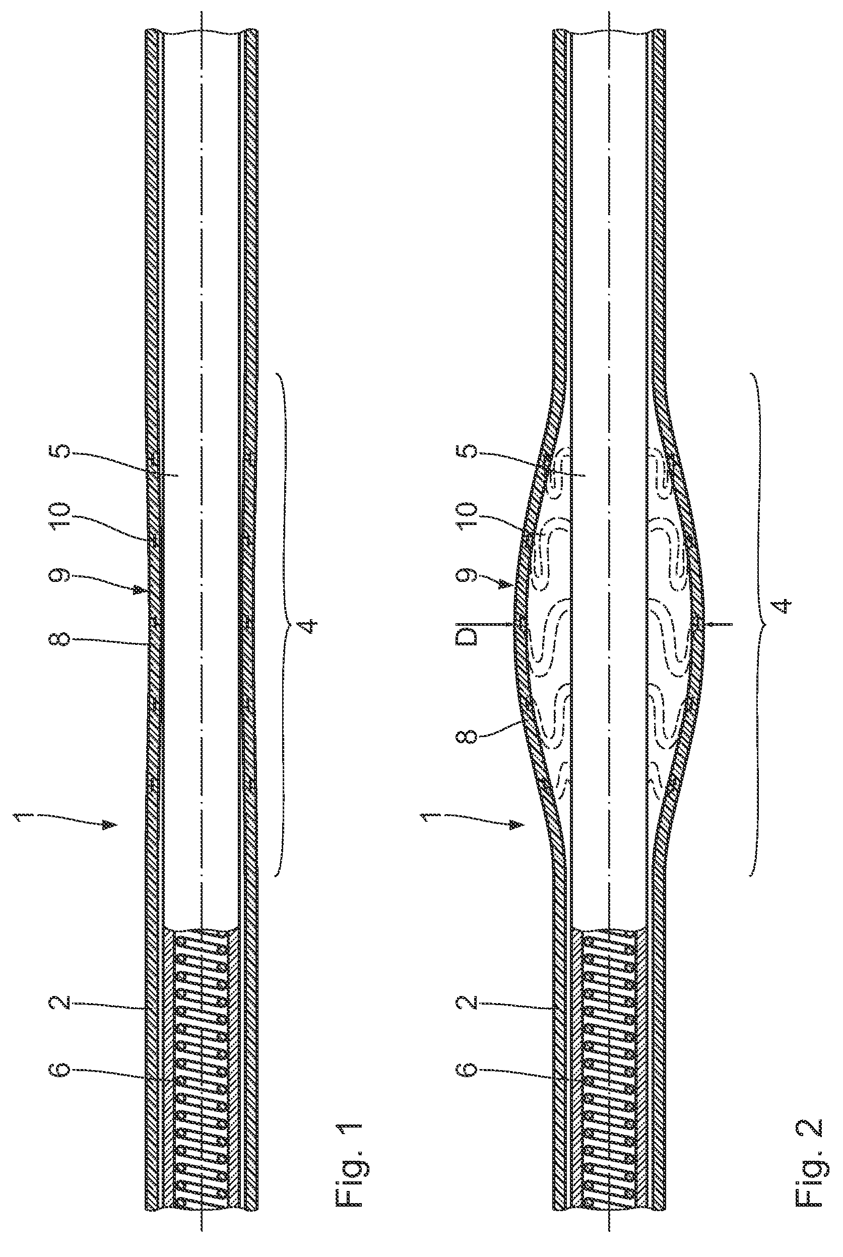 Implantable medical electrode device, in particular cardiovascular cardiac pacemaker or defibrillator electrode device