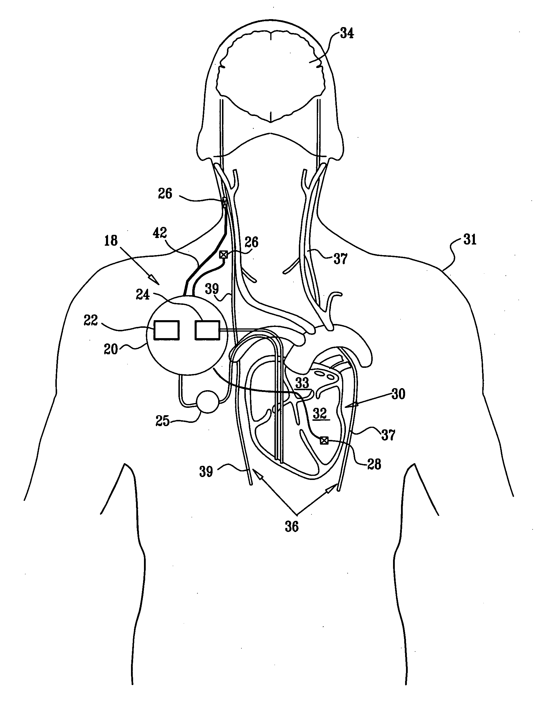 Parasympathetic pacing therapy during and following a medical procedure, clinical trauma or pathology