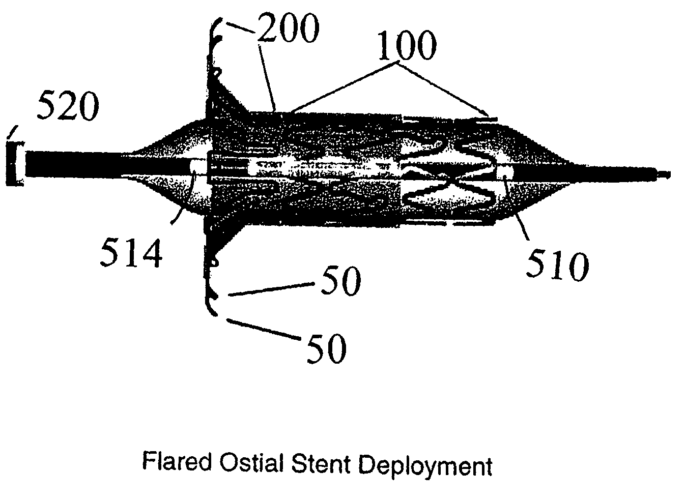 Flared ostial endoprosthesis and delivery system