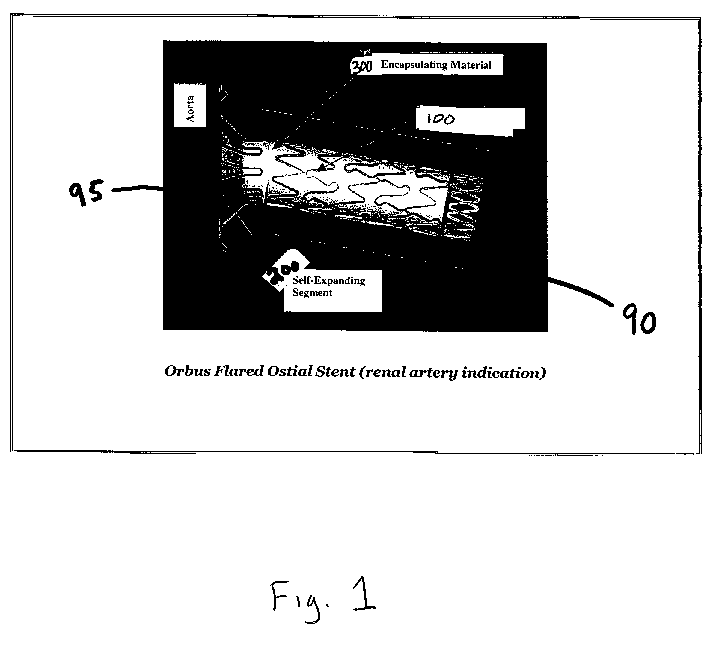 Flared ostial endoprosthesis and delivery system