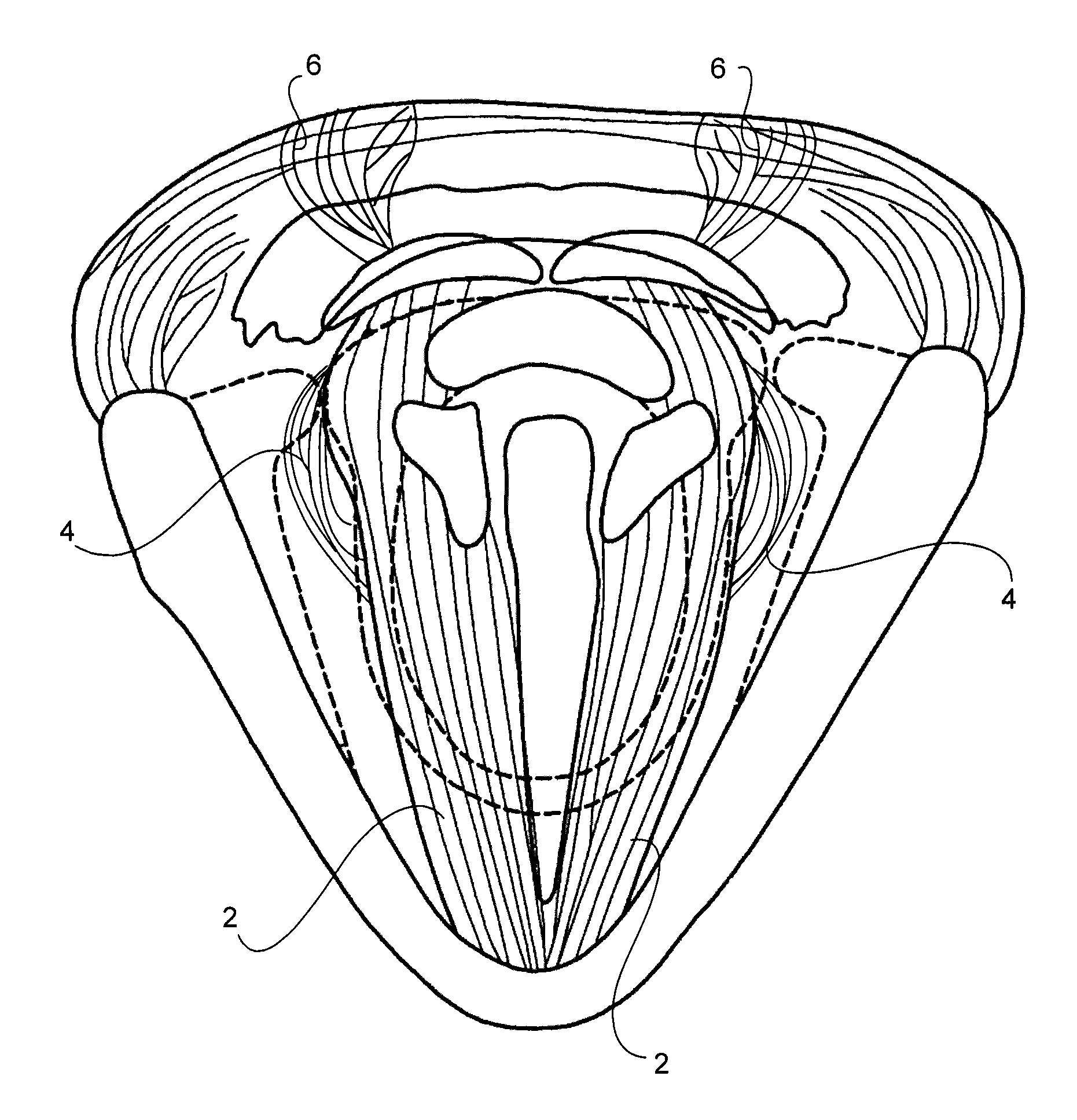 Method and apparatus for the treatment of spasmodic dysphonia