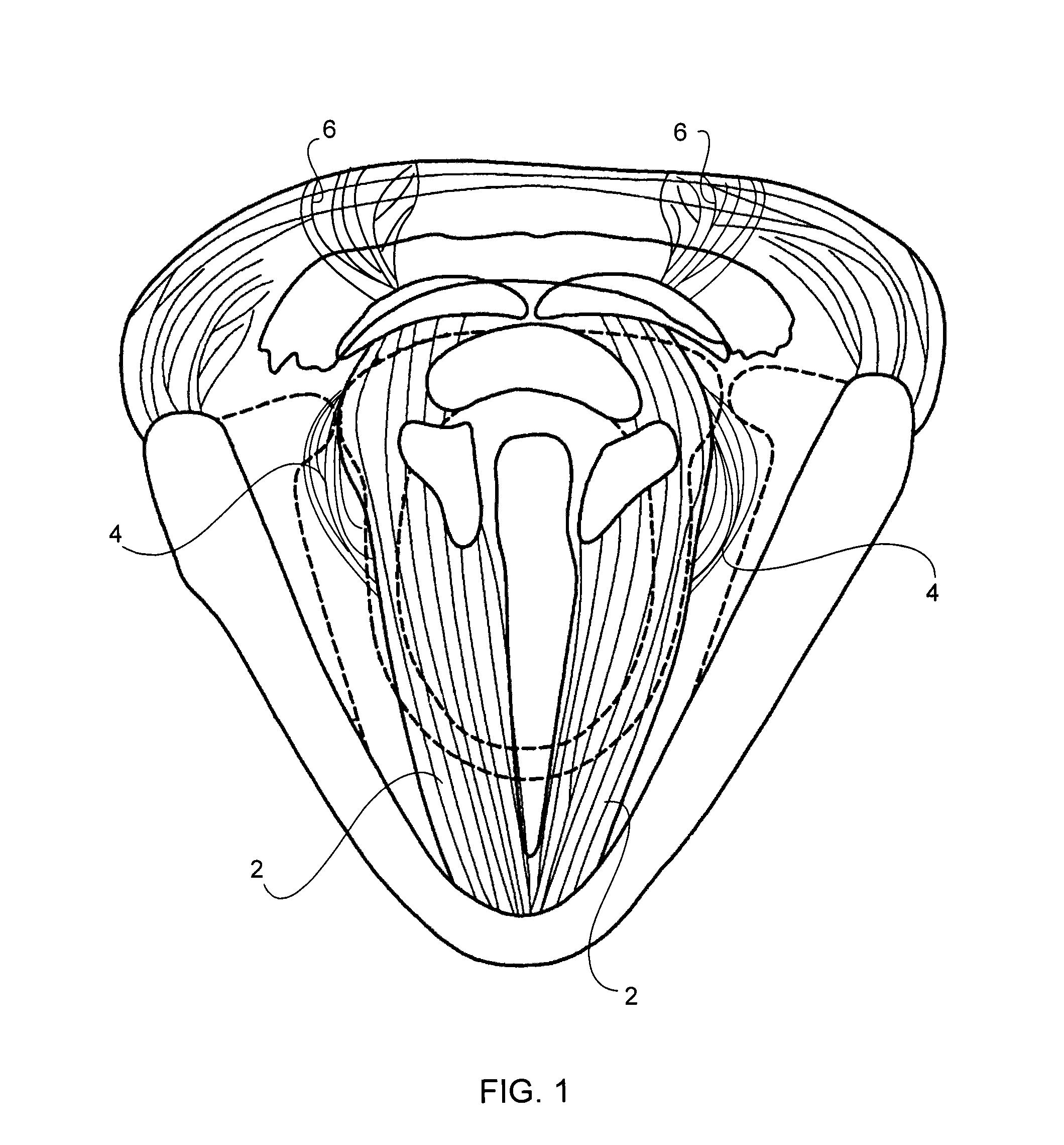 Method and apparatus for the treatment of spasmodic dysphonia