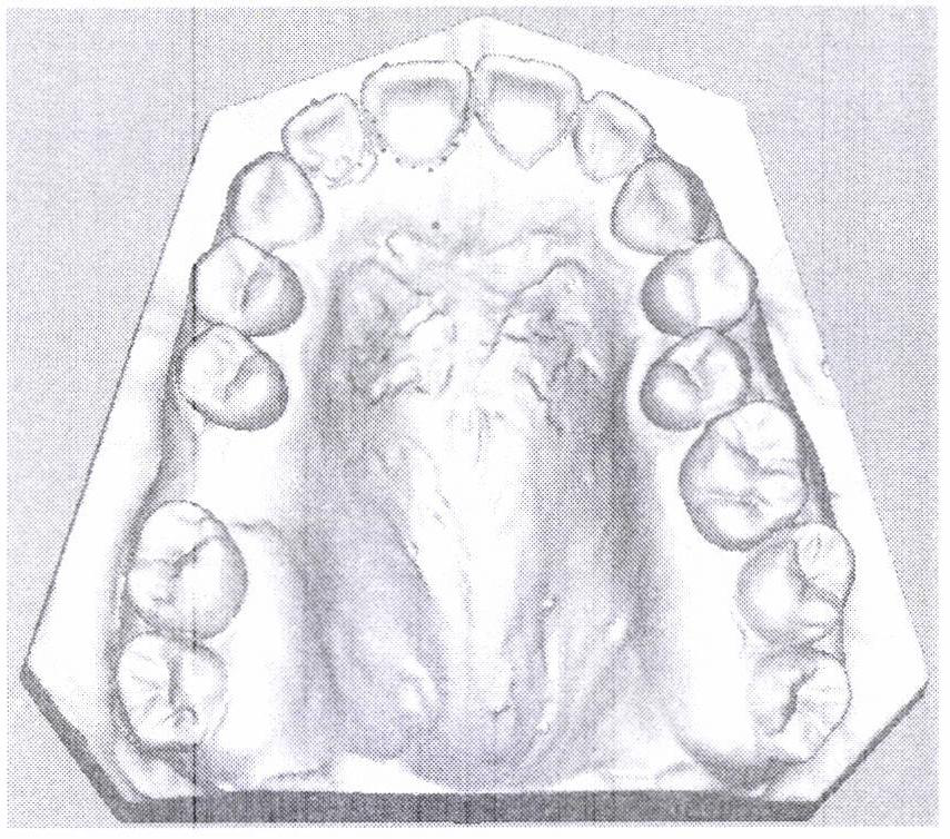 A Simulation Method of Gingival Deformation Based on the Mass Spring Model of Tooth Long Axis