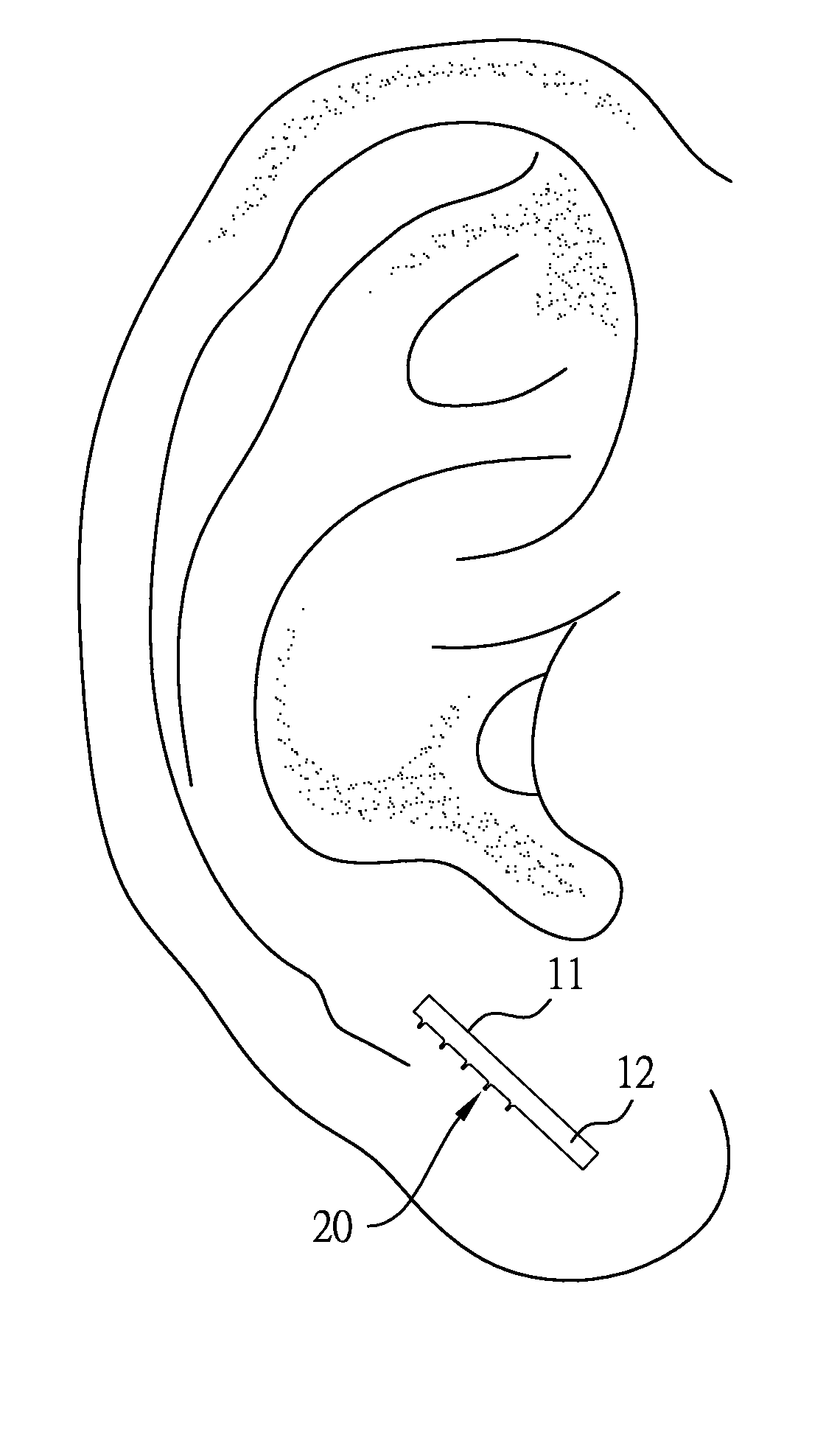 Press needles with an alignment structure