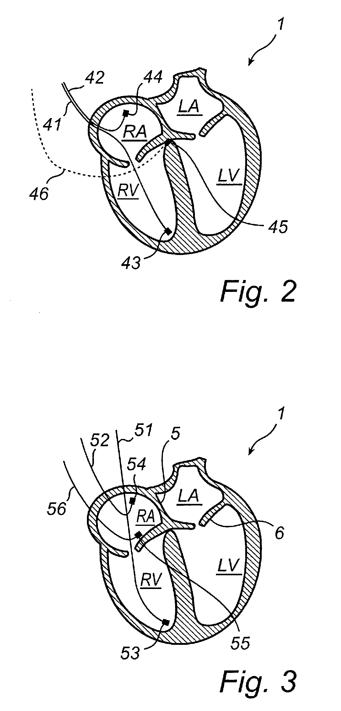 Implantable medical device and method for monitoring valve movements of a heart