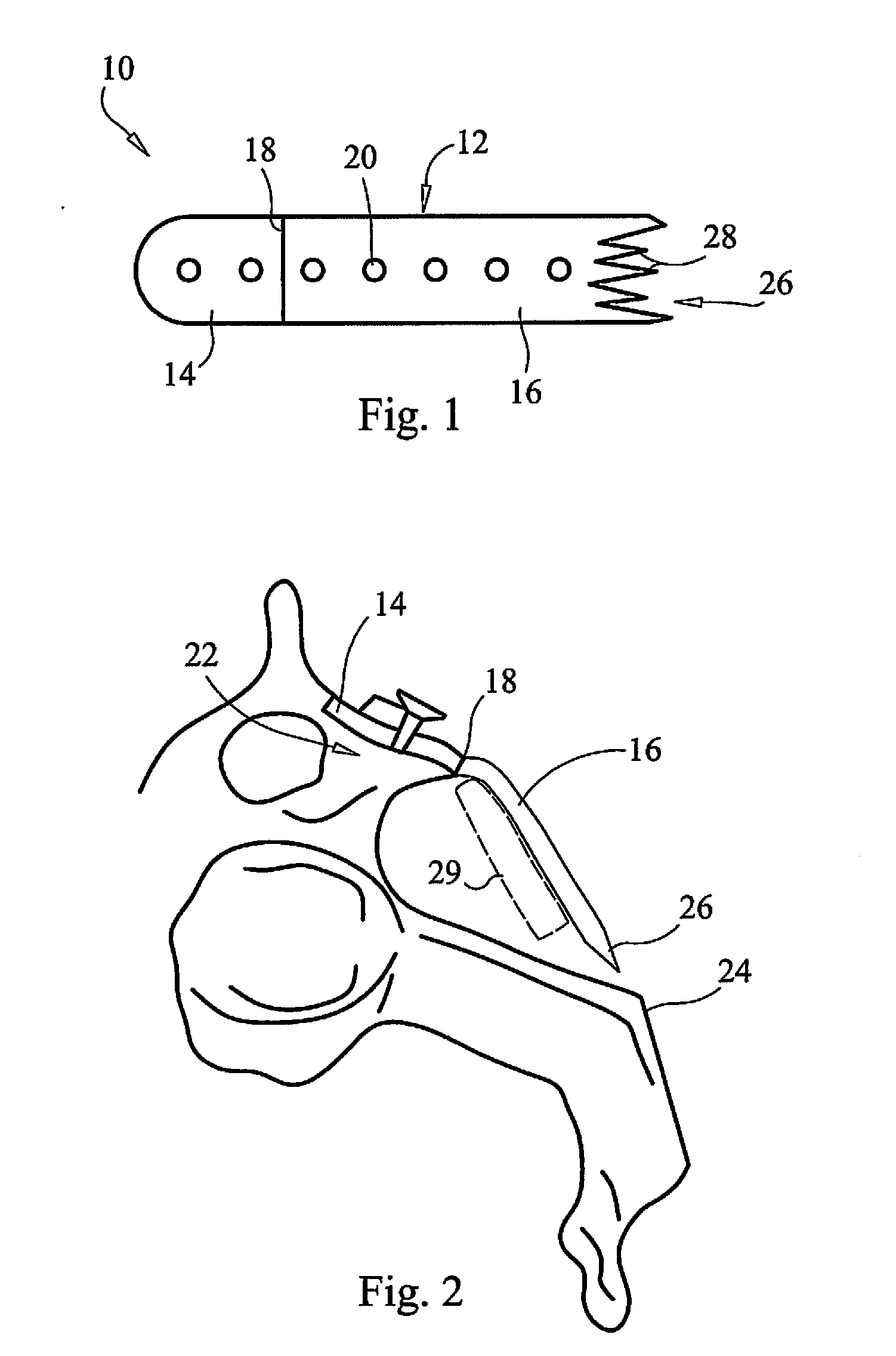 Laminoplasty fixation devices