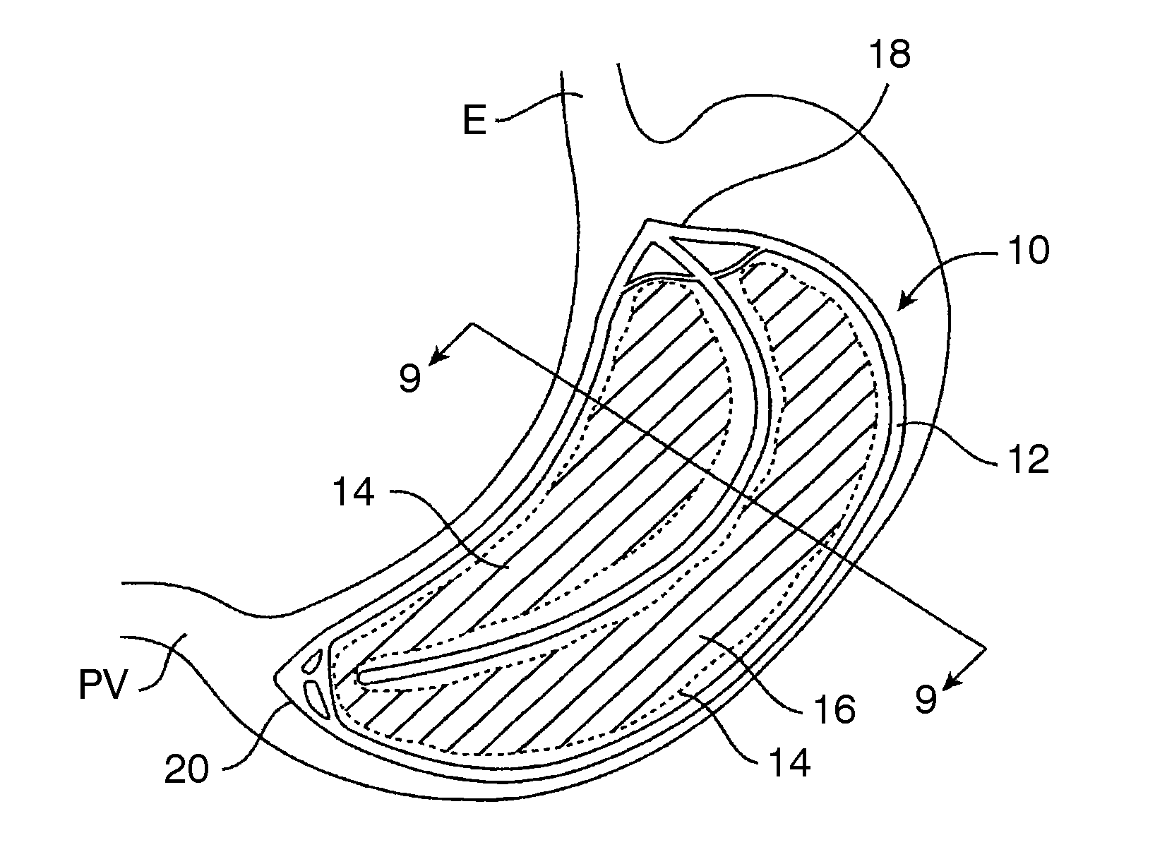 Methods, devices, and systems for obesity treatment