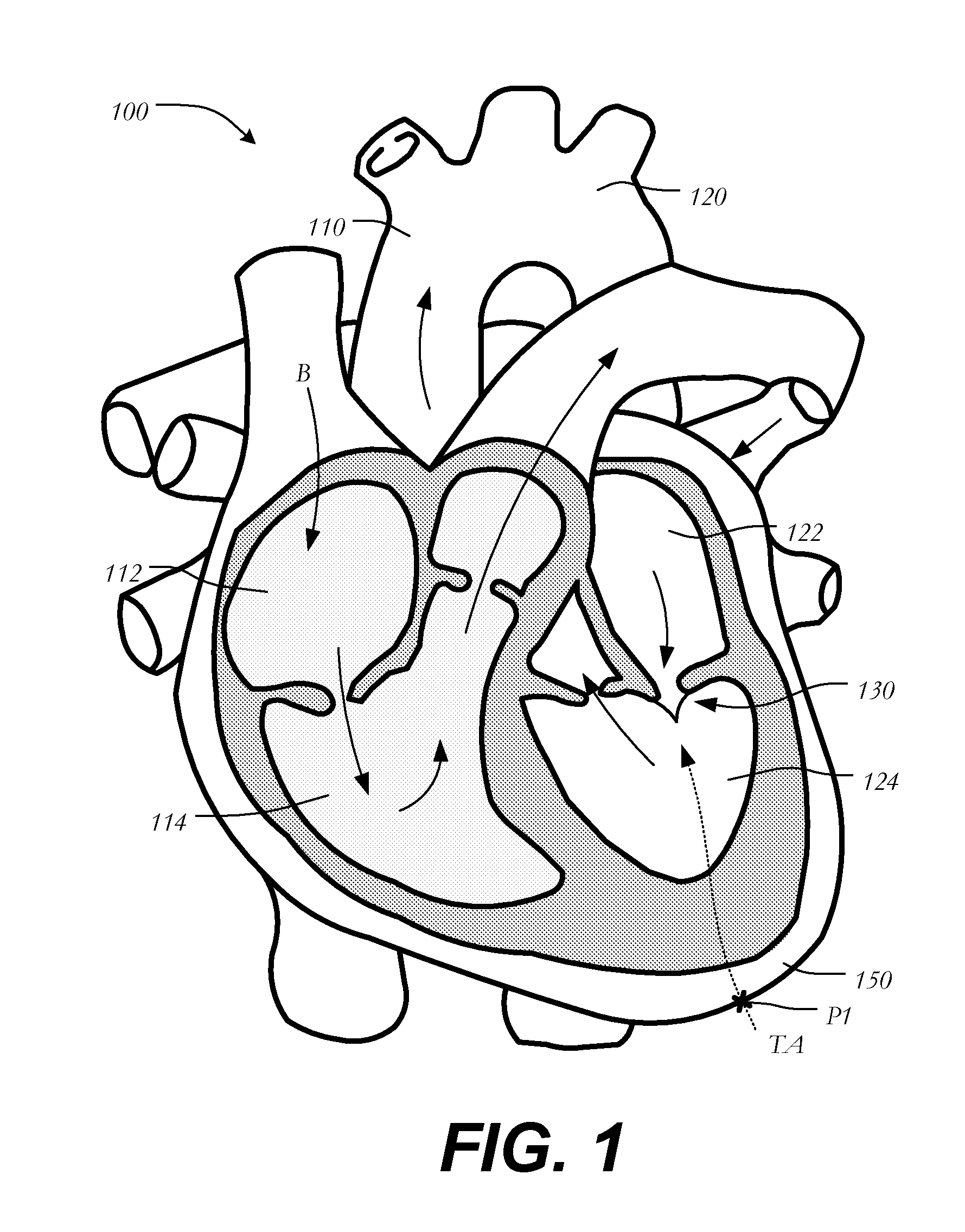 Transapical mitral chordae replacement