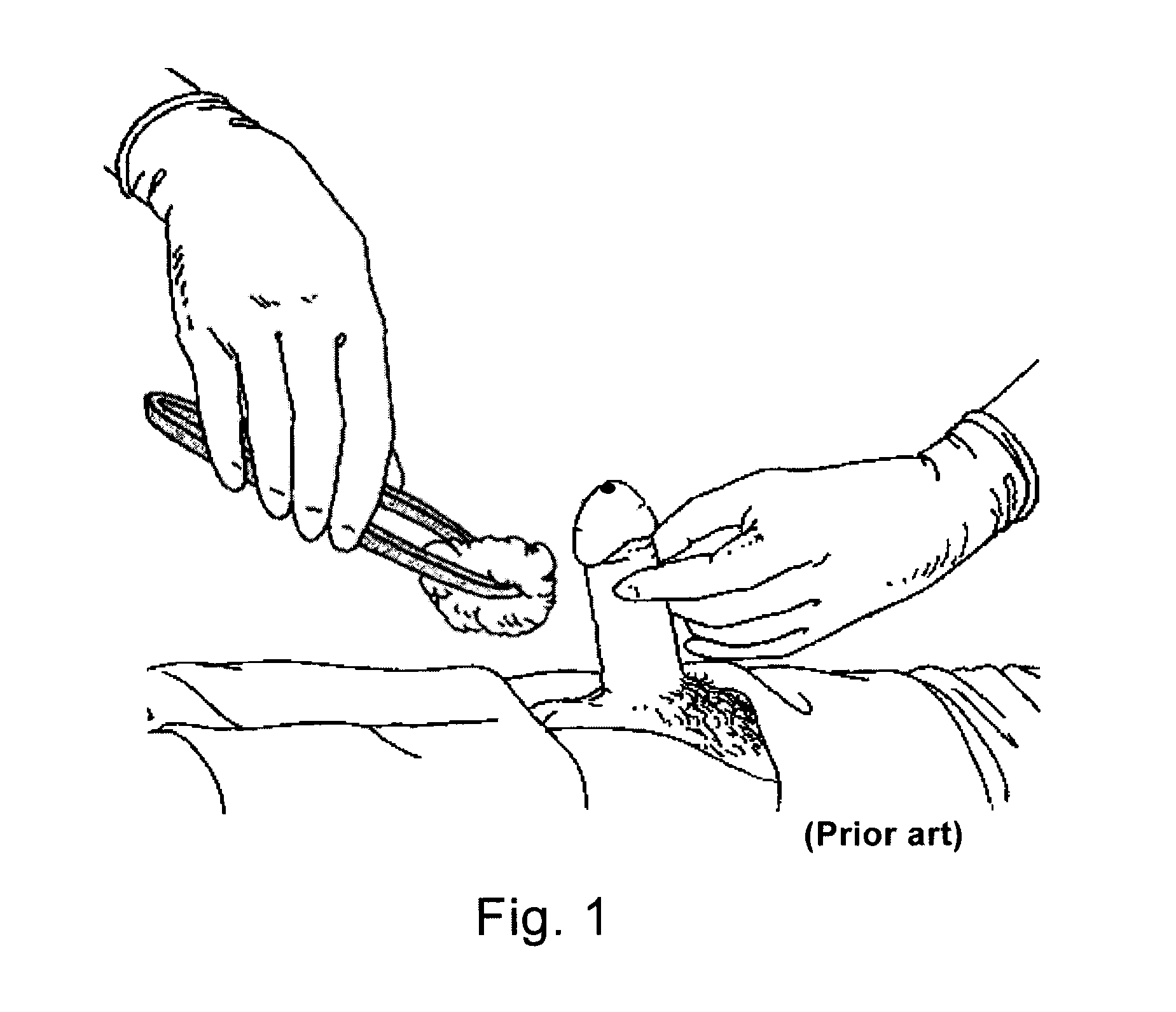 Surgical drape system for urology procedures on male patients