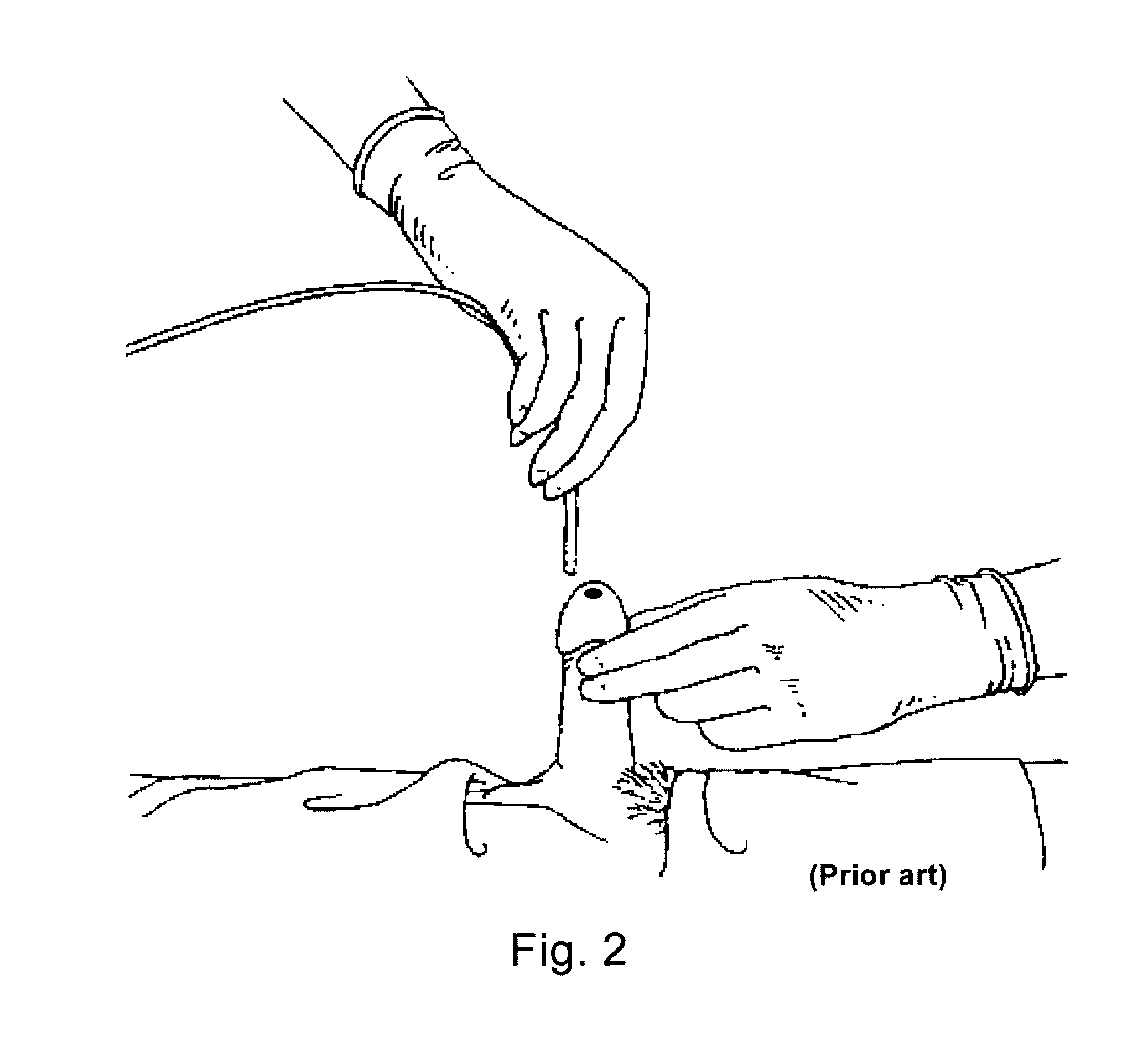 Surgical drape system for urology procedures on male patients