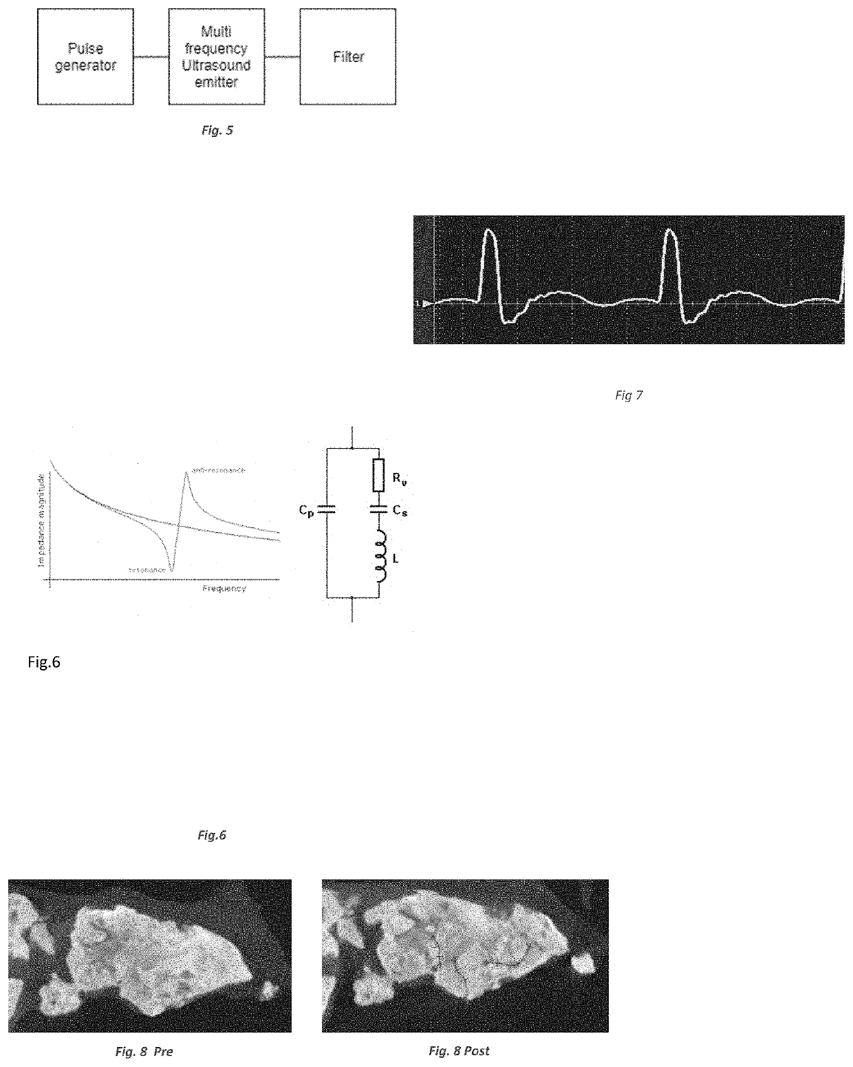 Device for the Treatment of Tissue Calcification