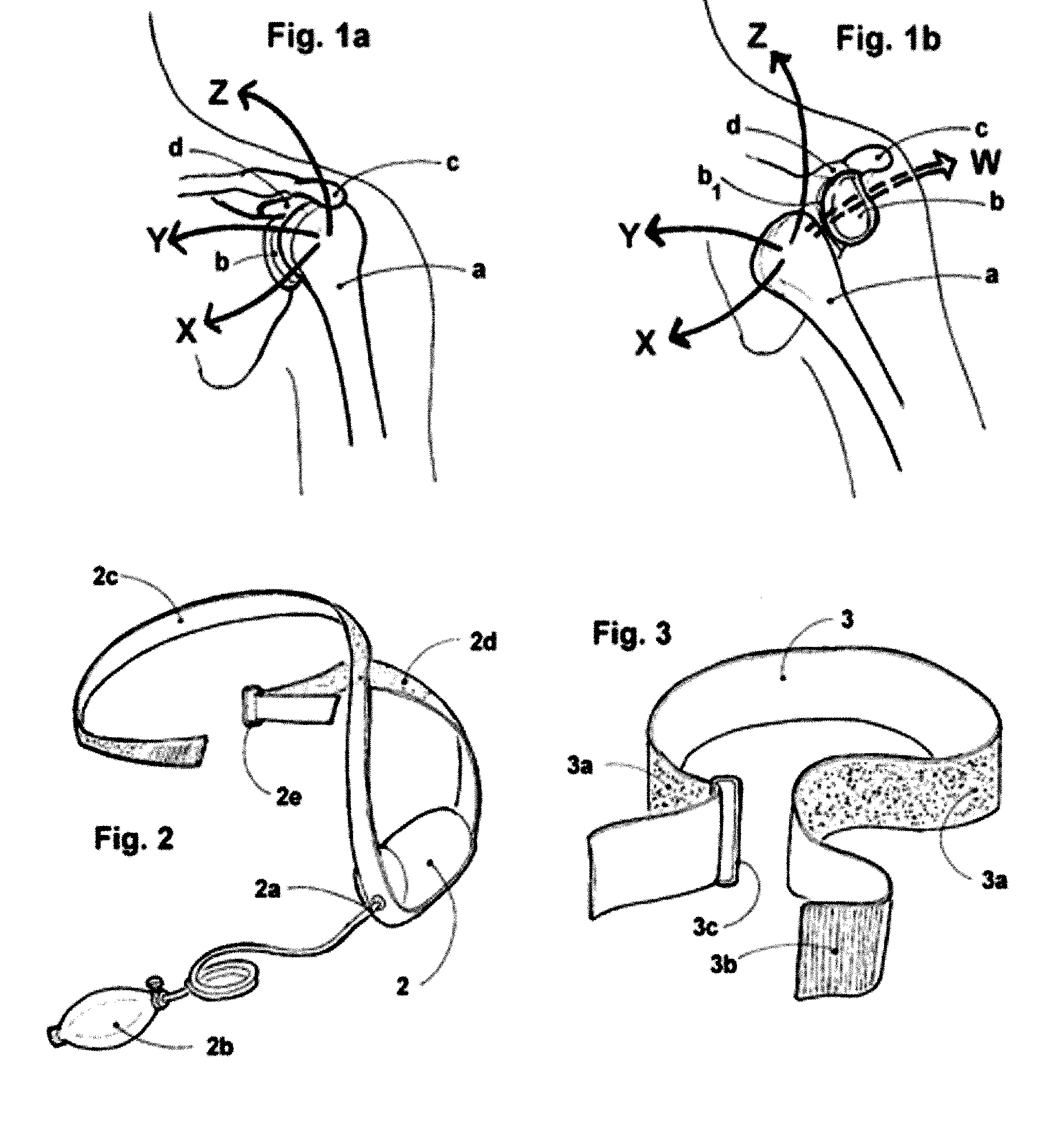 An orthopedic appliance and method to reduce anterior dislocation of shoulder and to provide post reduction immobilization