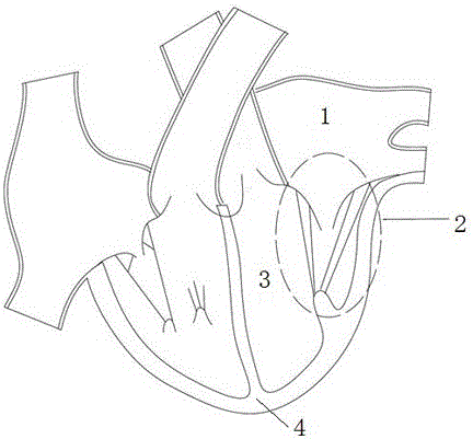 Mitral valve flexible closing plate blocking body implanted through cardiac apex and implantation method