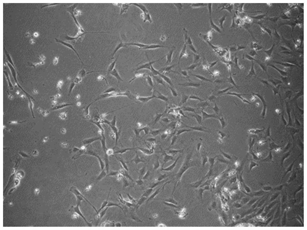 In-vitro amplification method and application of glioma-derived tumor infiltration lymphocytes (TIL)