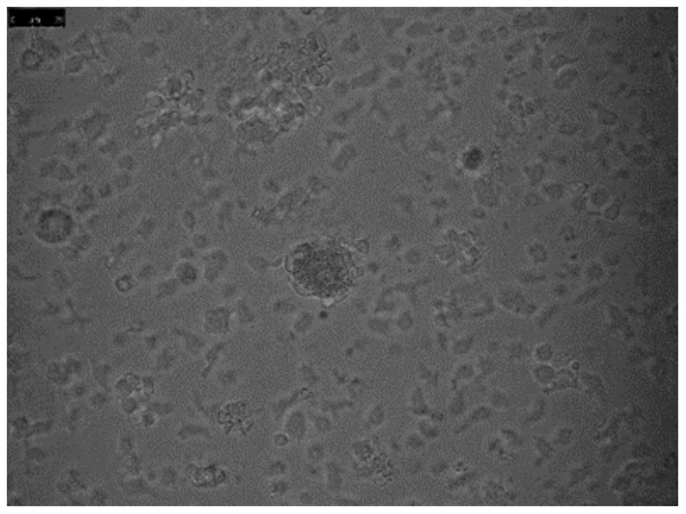 In-vitro amplification method and application of glioma-derived tumor infiltration lymphocytes (TIL)