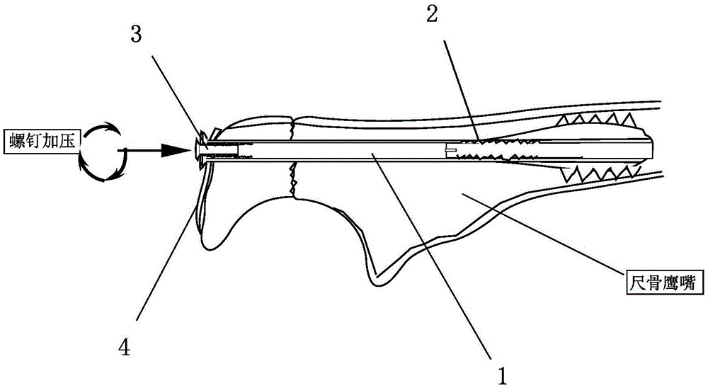 A pressurized intramedullary expansion locking nail and its manufacturing method