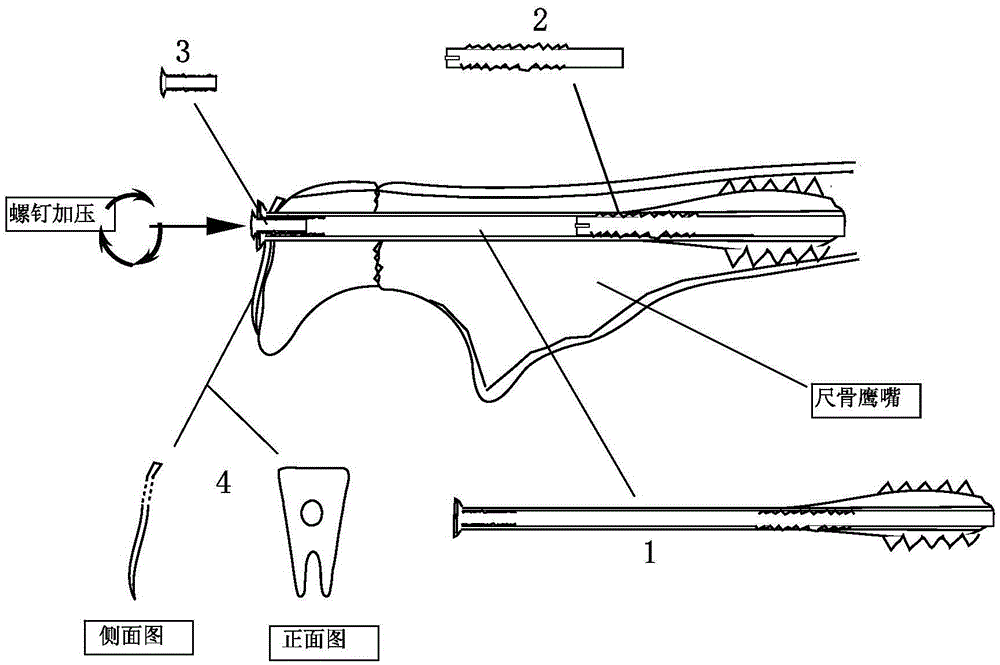 A pressurized intramedullary expansion locking nail and its manufacturing method