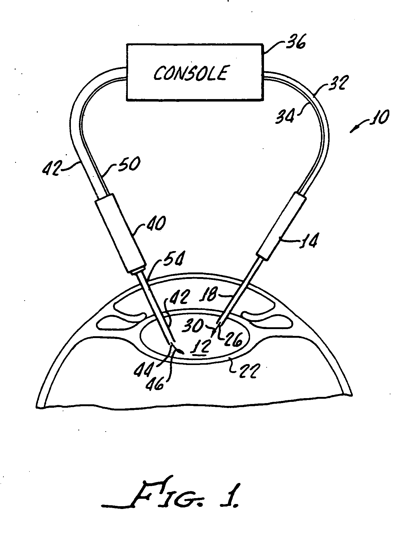 Cataract extraction apparatus and method with rapid pulse phaco power