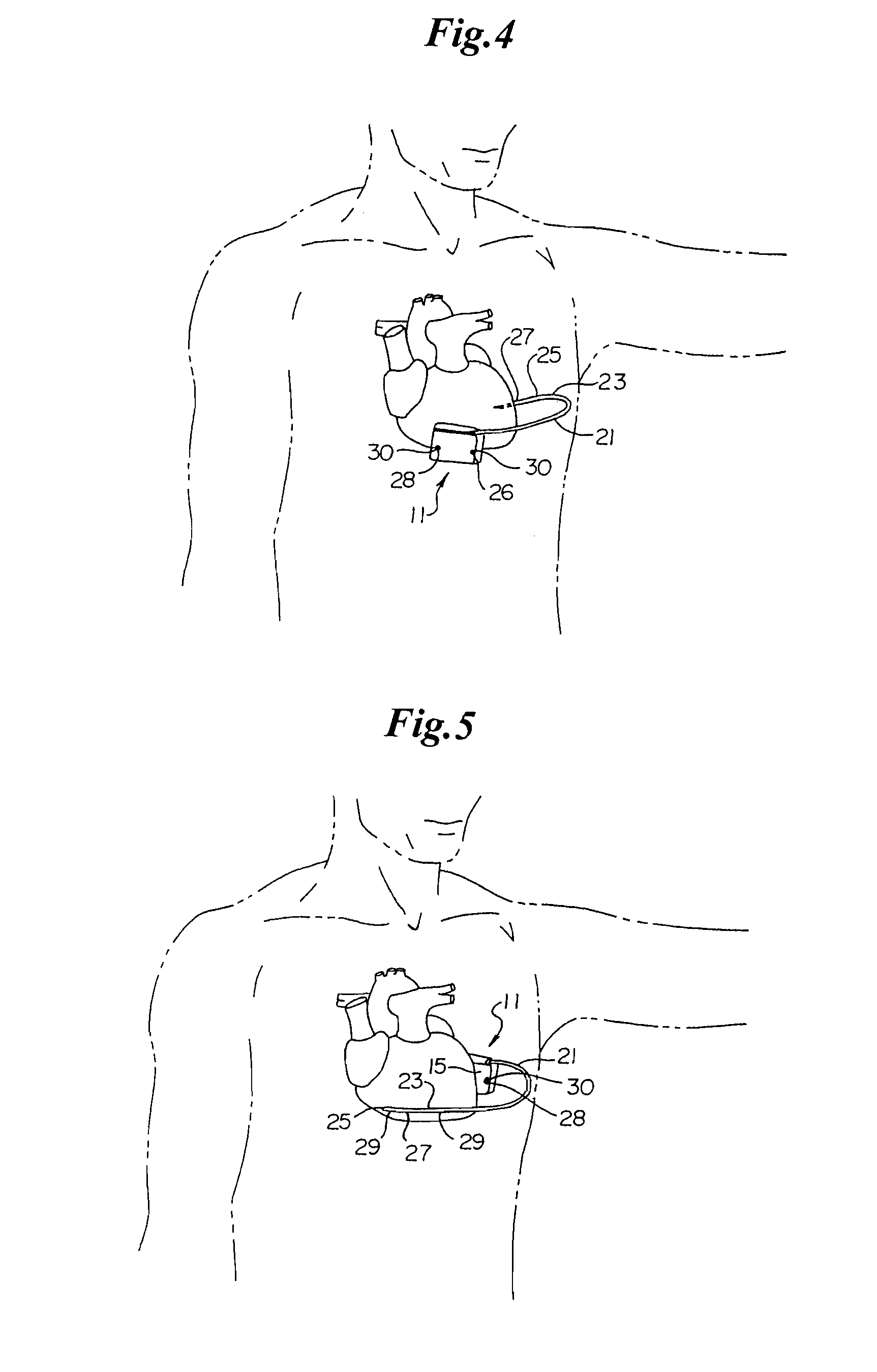 Bradycardia pacing in a subcutaneous device